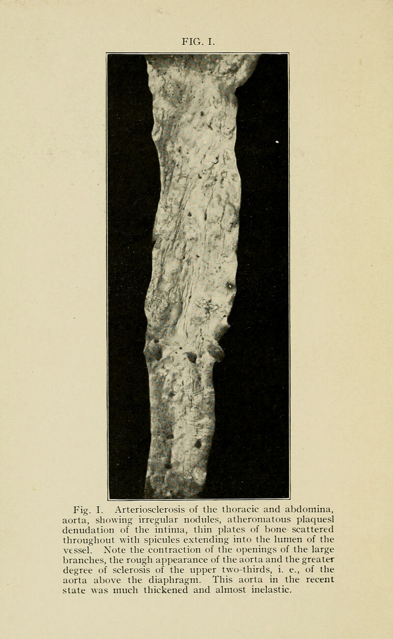 FIG. I. Fig. I. Arteriosclerosis of the thoracic and abdomina, aorta, showing irregular nodules, atheromatous plaquesl denudation of the intinia, thin plates of bone scattered throughout with spicules extending into the lumen of the vessel. Note the contraction of the openings of the large branches, the rough appearance of the aorta and the greater degree of sclerosis of the upper two-thirds, i. e., of the aorta above the diaphragm. This aorta in the recent state was much thickened and almost inelastic.