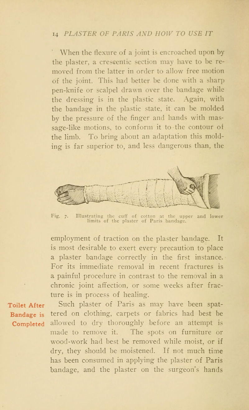 W'hen the tiexurc of a joint is encroached upon by the plaster, a cresu'cntic section may have to he re- moved from the latter in order to allow free motion of the joint. This had better be done with a sharp pen-knife or scalpel drawn over the bandag^e while the dressing is in the plastic state, .\gain, with the bandage in the plastic state, it can be molded by the pressure of the finger and hands with mas- sage-like motions, to conform it to the contour of the limb. To bring about an adaptation this mold- ing is far superior to, and less dangerous than, the Fig. 7. Illustrating the cuff of cotton at the upper and lower limits of the plaster of Paris bandage. employment of traction on the plaster bandage. It is most desirable to exert every precaution to place a plaster bandage correctly in the first instance. For its immediate removal in recent fractures is a painful procedure in contrast to the removal in a chronic joint affection, or some weeks after frac- ture is in process of healing. Toilet After Such plaster of Paris as may have been spat- Bandage is tered on clothing, carpets or fabrics had best be Completed allowed to dry thoroughly before an attempt is made to remove it. The spots on furniture or wood-work had best be removed while moist, or if dry, they should be moistened. If not much time has been consumed in applying the plaster of Paris bandage, and the plaster on the surgeon's hands