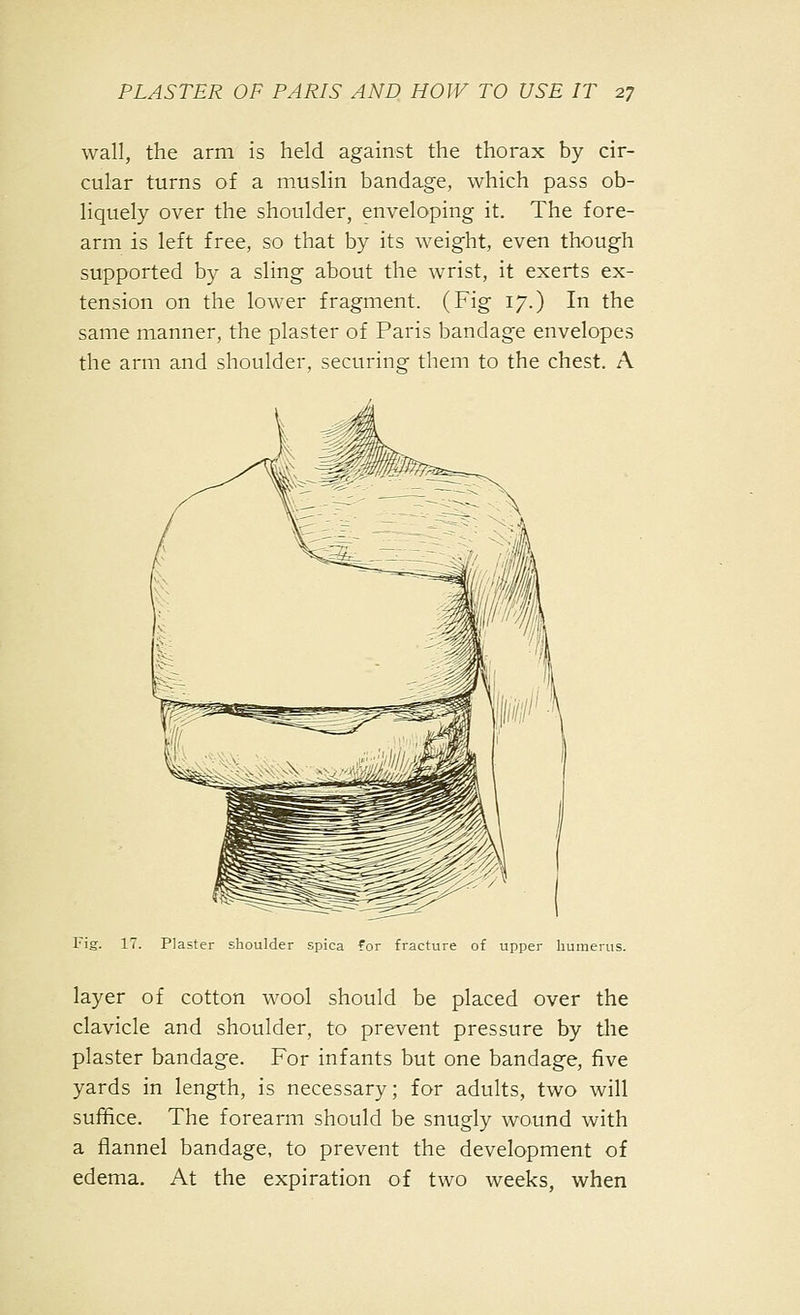 wall, the arm is held against the thorax by cir- cular turns of a muslin bandage, which pass ob- liquely over the shoulder, enveloping it. The fore- arm is left free, so that by its weight, even though supported by a sling about the wrist, it exerts ex- tension on the lower fragment. (Fig 17.) In the same manner, the plaster of Paris bandage envelopes the arm and shoulder, securing them to the chest. A Fig. 11 Plaster shoulder spica for fracture of upper humerus. layer of cotton wool should be placed over the clavicle and shoulder, to prevent pressure by the plaster bandage. For infants but one bandage, five yards in length, is necessary; for adults, two will suffice. The forearm should be snugly wound with a flannel bandage, to prevent the development of edema. At the expiration of two weeks, when