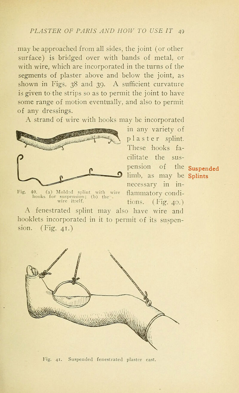 may be approached from all sides, the joint (or other surface) is bridged over with bands of metal, or with wire, which are incorporated in the turns of the segments of plaster above and below the joint, as shown in Figs. 38 and 39. A sufficient curvature is given to the strips so as to permit the joint to have some range of motion eventually, and also to permit of any dressings. A strand of wire with hooks may be incorporated in any variety of plaster splint. These hooks fa- cilitate the sus- pension of the Suspended limb, as may be Splints necessary in in- flammatory condi- tions. (Fig. 40.) A fenestrated splint may also have wire and booklets incorporated in it to permit of its suspen- sion. (Fig. 41.) 40. (a) Molded splint with wire hooks for suspension; (b) the . wire itself. Fig. 41. Suspended fenestrated plaster cast.