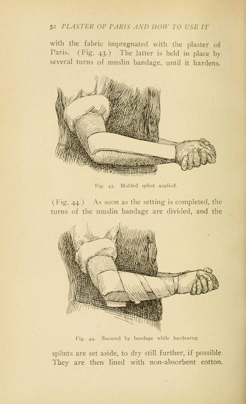 with the fabric impregnated with the plaster of Paris. (Fig. 43.) The latter is held in place by several turns of muslin bandage, until it hardens. Fig. 43. Molded splint ai'plicd. (Fig. 44.) As soon as the setting is completed, the turns of the muslin bandage are divided, and the Fig. 44. Secured by bandage while hardening. splints are set aside, to dry still further, if possible. They are then lined with non-absorbent cotton.