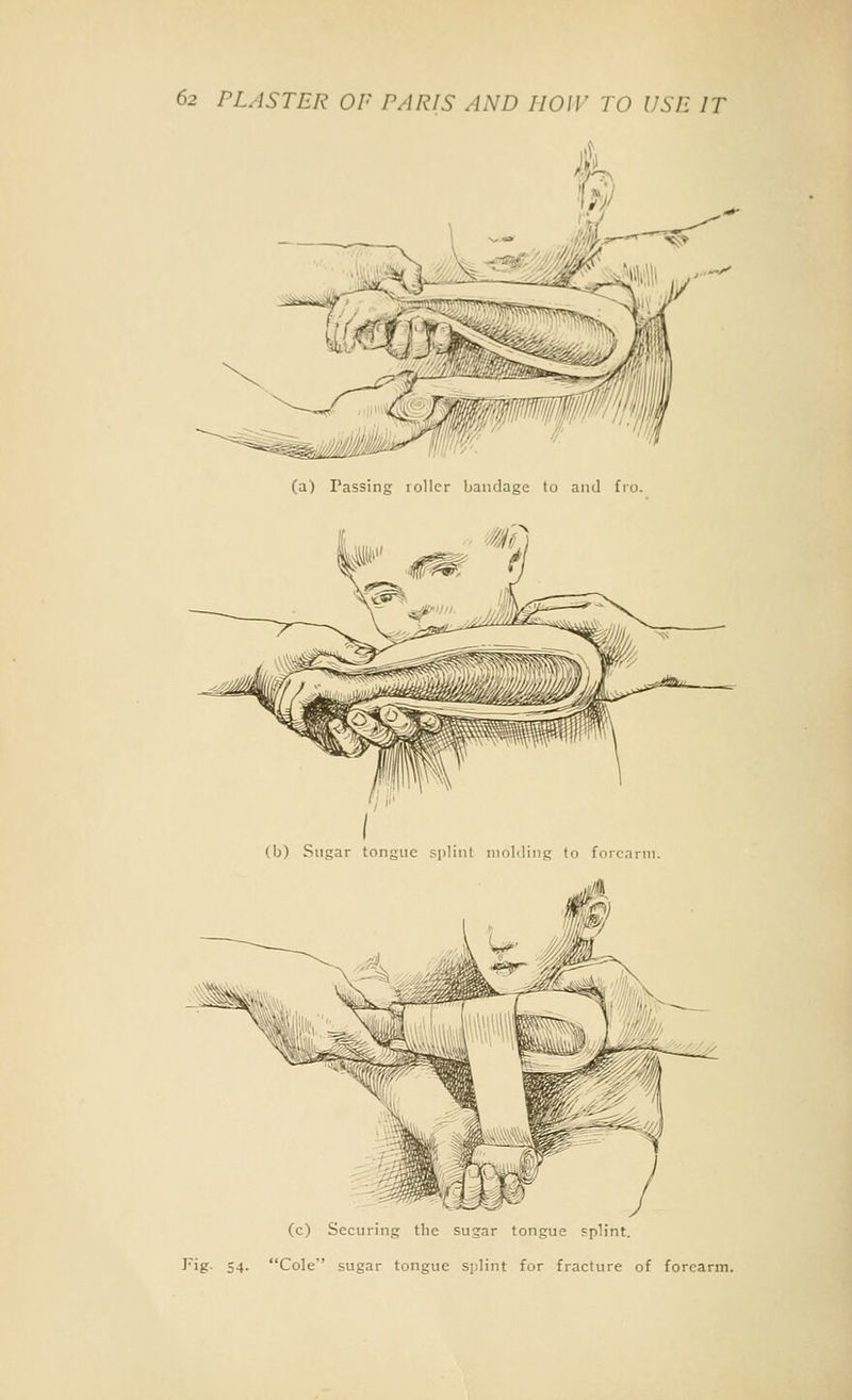 (a) Passing loUcr bandage to and fro. (c) Securing the sugar tongue splint. Fig. 54. Cole sugar tongue splint for fracture of forearm.