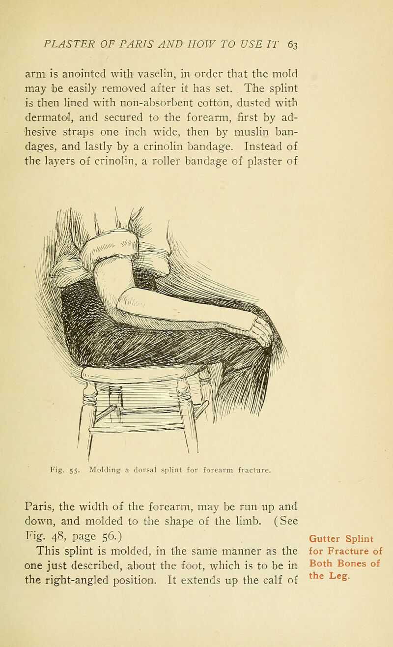 arm is anointed with vaselin, in order that the mold may be easily removed after it has set. The splint is then lined with non-absorbent cotton, dusted with dermatol, and secured to the forearm, first by ad- hesive straps one inch wide, then by muslin ban- dages, and lastly by a crinolin bandage. Instead of the layers of crinolin, a roller bandage of plaster of Fig. 55. Molding a dorsal splint for forearm fracture. Paris, the width of the forearm, may be run up and down, and molded to the shape of the limb. (See Fig. 48, page 56.) This splint is molded, in the same manner as the one just described, about the foot, which is to be in the right-angled position. It extends up the calf of Gutter Splint for Fracture of Both Bones of the Leg.