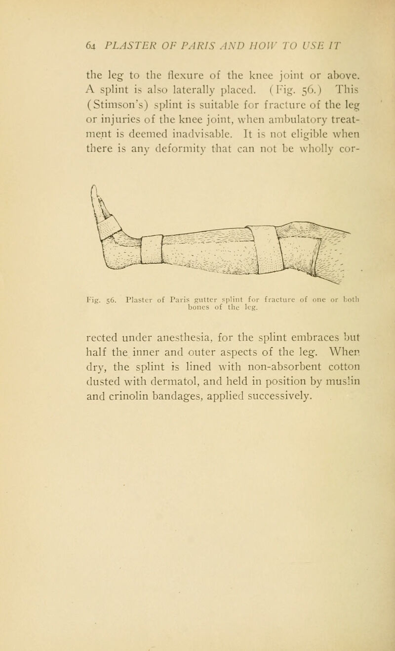 the leg; to the flexure of the knee joint or above. A splint is alst) laterally placed. {V\g. 56.) This (Stimson's) si>lint is suitable for fracture of the leg or injuries of the knee joint, when ambulatory treat- ment is deemed inadvisable. It is not eligible when there is any deformity that can not be wholly cor- l'ig. 56. Plastci- of Paris Ruttcr splint for fracture of one or hotli bones of tile leg. rected under anesthesia, for the splint embraces but half the inner and outer aspects of the leg. When dry, the splint is lined with non-absorbent cotton dusted with dermatol, and held in position by muslin and crinolin bandages, applied successively.