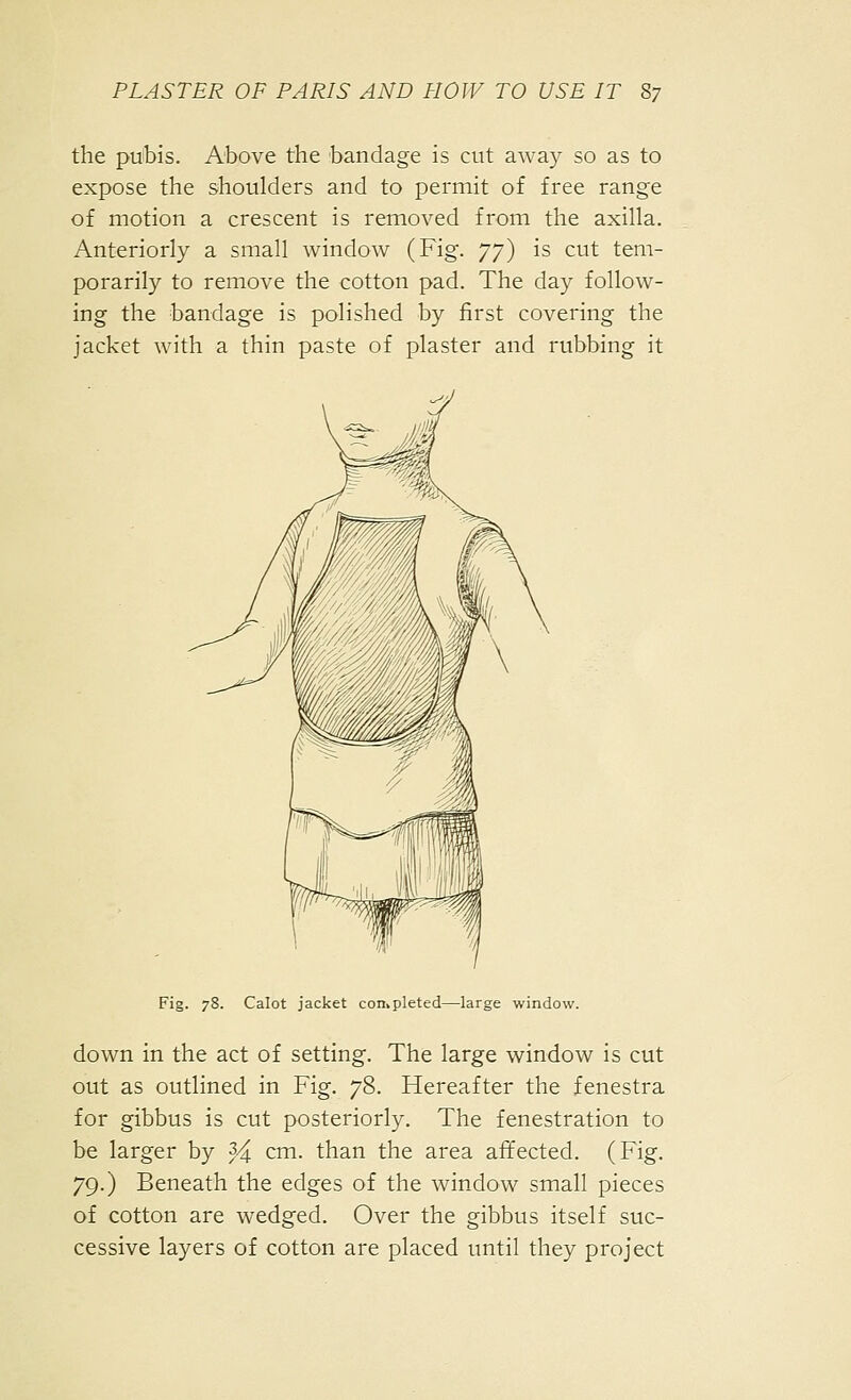 the pubis. Above the bandage is cut away so as to expose the shoulders and to permit of free range of motion a crescent is removed from the axilla. Anteriorly a small window (Fig. yy) is cut tem- porarily to remove the cotton pad. The day follow- ing the bandage is polished by first covering the jacket with a thin paste of plaster and rubbing it Fig. 78. Calot jacket completed—large window. down in the act of setting. The large window is cut out as outlined in Fig. 78. Hereafter the fenestra for gibbus is cut posteriorly. The fenestration to be larger by 3^ cm. than the area affected. (Fig. 79.) Beneath the edges of the window small pieces of cotton are wedged. Over the gibbus itself suc- cessive layers of cotton are placed until they project