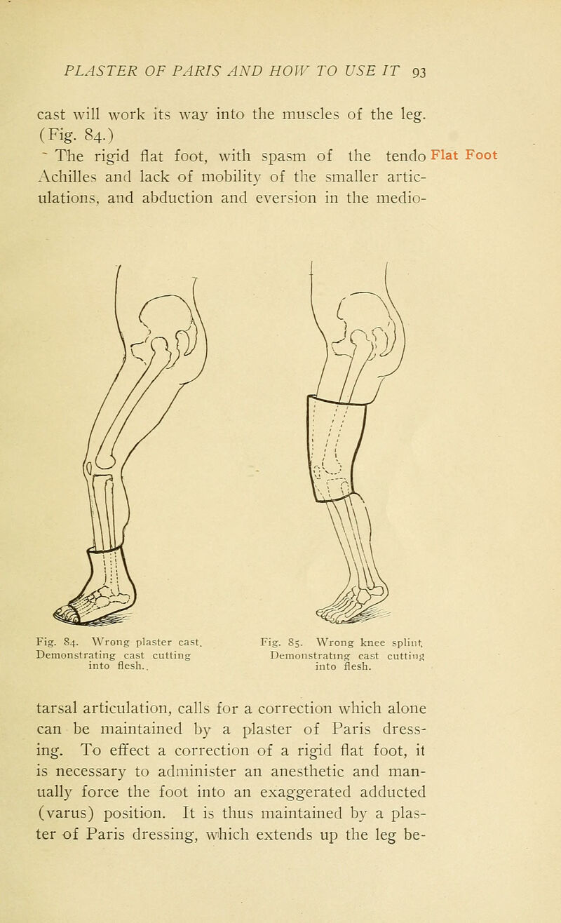 cast will work its way into the muscles of the leg. (Fig. 84.) ~ The rigid flat foot, with spasm of the tendo Flat Foot Achilles and lack of mobility of the smaller artic- ulations, and abduction and eversion in the medio- Fig. 84. ^\'rong plaster cast. Demonstrating cast cutting into flesli.. Fig. 85. Wrong knee splint. Demonstrating cast cutting into flesh. tarsal articulation, calls for a correction which alone can be maintained by a plaster of Paris dress- ing. To effect a correction of a rigid flat foot, it is necessary to administer an anesthetic and man- ually force the foot into an exaggerated adducted (varus) position. It is thus maintained by a plas- ter of Paris dressing, which extends up the leg be-