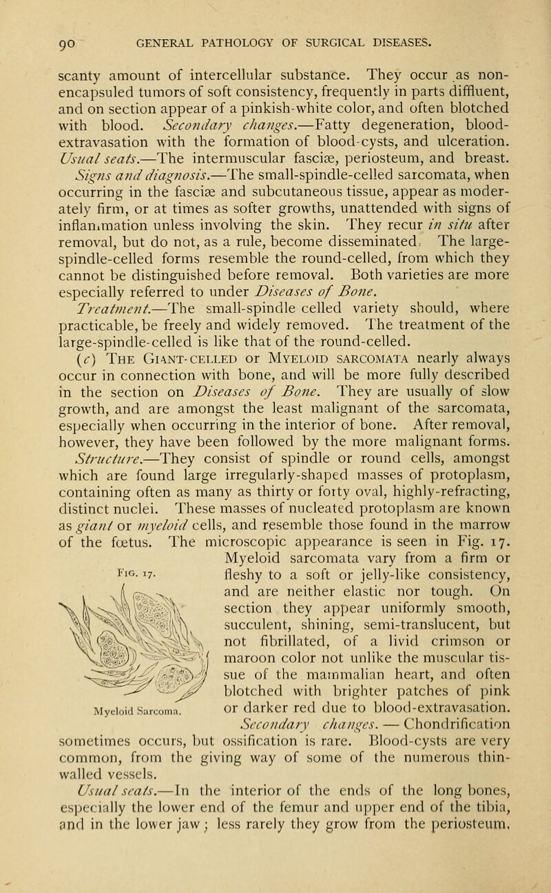 scanty amount of intercellular substance. They occur as non- encapsuled tumors of soft consistency, frequently in parts diffluent, and on section appear of a pinkish-white color, and often blotched with blood. Secojuiary changes.—Fatty degeneration, blood- extravasation with the formation of blood-cysts, and ulceration. Usual seats.—The intermuscular fasci?e, periosteum, and breast. Signs and diagnosis.—The small-spindle-celled sarcomata, when occurring in the fascige and subcutaneous tissue, appear as moder- ately firm, or at times as softer growths, unattended with signs of inflanimation unless involving the skin. They recur in situ after removal, but do not, as a rule, become disseminated: The large- spindle-celled forms resemble the round-celled, from which they cannot be distinguished before removal. Both varieties are more especially referred to under Diseases of Bone. Treatment.—The small-spindle celled variety should, where practicable, be freely and widely removed. The treatment of the large-spindle-celled is like that of the round-celled. {c) The Gi-vnt-celled or Myeloid sarcomata nearly always occur in connection with bone, and will be more fully described in the section on Diseases of Bone. They are usually of slow growth, and are amongst the least malignant of the sarcomata, especially when occurring in the interior of bone. After removal, however, they have been followed by the more malignant forms. Structure.—They consist of spindle or round cells, amongst which are found large irregularly-shaped masses of protoplasm, containing often as many as thirty or forty oval, highly-refracting, distinct nuclei. These masses of nucleated protoplasm are known as giant or myeloid cells, and resemble those found in the marrow of the foetus. The microscopic appearance is seen in Fig. 17. Myeloid sarcomata vary from a firm or fleshy to a soft or jelly-like consistency, and are neither elastic nor tough. On section they appear uniformly smooth, succulent, shining, semi-translucent, but not fibrillated, of a livid crimson or maroon color not unlike the muscular tis- sue of the mammalian heart, and often blotched with brighter patches of pink or darker red due to blood-extravasation. Secondary changes. — Chondrification sometimes occurs, but ossification is rare. Blood-cysts are very common, from the giving way of some of the numerous thin- walled vessels. Usual seats.—In the interior of the ends of the long bones, es])ecially the lower end of the femur and u]:)per end of the tibia, and in the lower jaw; less rarely they grow from the periosteum, Fig Myeloid Sarcoma.