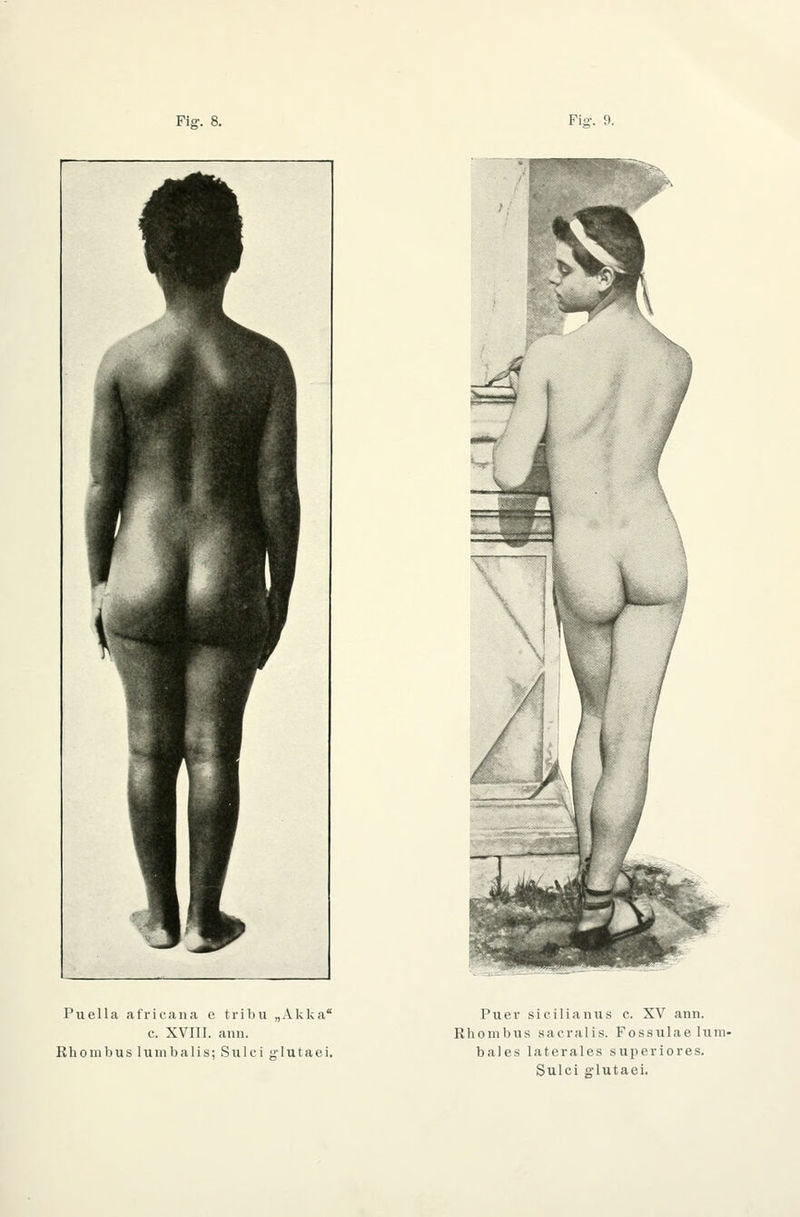 Puella africjina c tribu „Akka c. XVIII. aun. Rhombus hiinbalis; Sulci g-lutaei. Puer sicilianus c. XV ann. Rhombus sacralis. Fossulae lum- bales laterales superiores. Sulci g'lutaei.