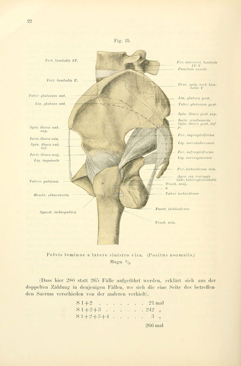 Vrrt. hnnhalis IV. Verf. Inmhalis V Tuhi'T f/hititpum anf. Lhi. tjlutitea mit. Sph}. üiaca anf. anp. JnciR.ifificavnn. Sjiin. Üiaca ant. inf, Iiicis. iliaca mnj. Liy. inguinale Tüfterc. pufiicuvi Mciiihr. ohturaforia Sytiost. ischiopvhica For. hiffrrf'Vf. Iiiriilinlfi 1 y- y. I'itnrfu'ni viKfidc Proc. ftpin. vorl. Uim- fxdh V Lin. iflufaca post. Tulicr (ilvtafium 3>osf. Sphi. Hiara post. 8uj). Incis. ftriiiilunaris ^ij'i'i- iliaca posf. inf. P- For. suprapirifor'me JJtj. S(icrntul}f'.rosum For. infropirifornie Liff. sacroüpinoswin For. ischiiiifiru7n min. Apex 088. coccy(jiR — Sidr. ftiheroiße.noidalis Troch. >ii<ij. u Tulier iurhiailii-um Piinct. iscliiadicittn Troch. viin. Pelvis feminae a latere sinistro visa. (Positus nornialis.) Mag-n. 1/2. (Dass liier 280 statt 2i^iy Fälle aiifi;-eiMlirt. werden, erklärt sieh ans der (loni)elteii Zälilnni;* in denjenigen Füllen, wo sieh die eine Seite des betreften- den Saeruiii versehiedeu von der anderen verhielt). Sl+2 21 mal S 1+2+3 242 „ S 1+2+3+4 3 „ 266 mal