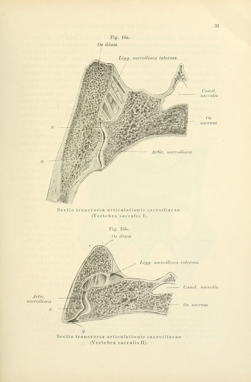 Fiff. KJa.. Os ilium Liiia. sacruäiaca inteross. X Cm Uli. sacfaliti Os nacriim Artic. sacroUiaca Sectio transversa articulatiouis siicroiliacae (Vortfbra sacralis I). Artic. sacroUiaca Fig. 16b. Ox iiiutn Li<l<J. .sticroiU.ica iiift'ros.t. Caniil. .V(R7'((/(,s Sectio transversa articulati o nis saeroiliacae (Vertebra sacralis II).