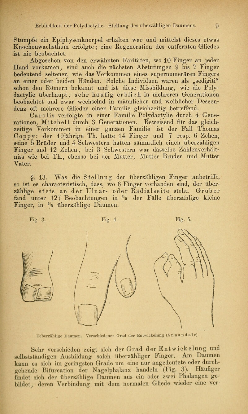 Stumpfe ein Epiphysenknorpel erhalten war und mittelst dieses etwas Knochenwachsthum erfolgte; eine Regeneration des entfernten Gliedes ist nie beobachtet. Abgesehen von den erwähnten Raritäten, wo 10 Finger an jeder Hand vorkamen, sind auch die nächsten Abstufungen 9 bis 7 Finger bedeutend seltener, wie das Vorkommen eines supernumerären Fingers an einer oder beiden Händen. Solche Individuen waren als ^^sedigiti schon den Römern bekannt und ist diese Missbildung, wie die Poly- dactylie überhaupt, sehr häufig erblich in mehreren Generationen beobachtet und zwar wechselnd in männlicher und weiblicher Descen- denz oft mehrere Glieder einer Familie gleichzeitig betreffend. Carolis verfolgte in einer Familie Polydactylie durch 4 Gene- rationen, Mitchell durch 3 Generationen. Beweisend für das gleich- zeitige Vorkommen in einer ganzen Familie ist der Fall Thomas Coppy: der 19jährige Th. hatte 14 Finger und 7 resp. 6 Zehen, seine 5 Brüder und 4 Schwestern hatten sämmtlich einen überzähligen Finger und 12 Zehen, bei 3 Schwestern war dasselbe Zahlenverhält- niss wie bei Th., ebenso bei der Mutter, Mutter Bruder und Mutter Vater. §. 13. Was die Stellung der überzähligen Finger anbetrifft, so ist es characteristisch, dass, wo 6 Finger vorhanden sind, der über- zählige stets an der Ulnar- oder Radialseite steht. Gruber fand unter 127 Beobachtungen in ^/s der Fälle überzählige kleine Finger, in ^/s überzählige Daumen. Fig. Fig. 4. Fig. 5. Ueberzähllge Daumen. Verschiedener Grad der Entwickelung (An n a n d a 1 c). Sehr verschieden zeigt sich der Grad der Entwickelung und selbstständigen Ausbildung solch überzähliger Finger. Am Daumen kann es sich im geringsten Grade um eine nur angedeutete oder durch- gehende Bifurcation der Nagelphalanx handeln (Fig. 3). Häufiger findet sich der überzählige Daumen aus ein oder zwei Phalangen ge- bildet, deren Verbindung mit dem normalen Gliede wieder eine ver-