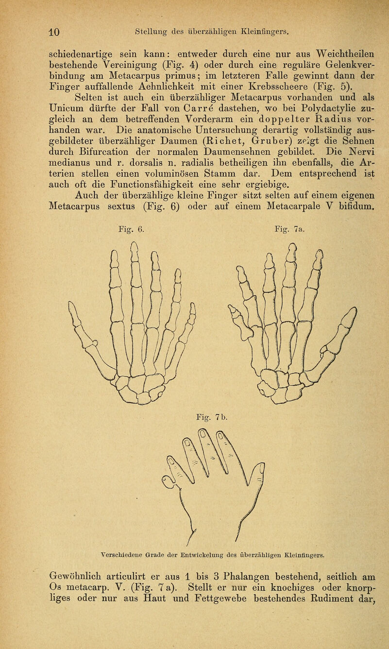 schiedenartige sein kann: entweder durch eine nur aus Weichtheilen bestehende Vereinigung (Fig. 4) oder durch eine reguläre Gelenkver- bindung am Metacarpus primus; im letzteren Falle gewinnt dann der Finger auffallende Aehnlichkeit mit einer Krebsscheere (Fig. 5). Selten ist auch ein überzähliger Metacarpus vorhanden und als Unicum dürfte der Fall von Carrd dastehen^ wo bei Polydactjlie zu- gleich an dem betreffenden Vorderarm ein doppelter Radius vor- handen war. Die anatomische Untersuchung derartig vollständig aus- gebildeter überzähliger Daumen (Eichet, Gruber) zeigt die Sehnen durch Bifurcation der normalen Daumensehnen getjildet. Die Nervi medianus und r. dorsalis n. radialis betheiligen ihn ebenfalls, die Ar- terien stellen einen voluminösen Stamm dar. Dem entsprechend ist auch oft die Functionsfähigkeit eine sehr ergiebige. Auch der überzählige kleine Finger sitzt selten auf einem eigenen Metacarpus sextus (Fig. 6) oder auf einem Metacarpale V bifidum. Fig. 7a. Verscliiedene Grade der Entwickelung des überzähligen Kleinfingers. Gewöhnlich articulirt er aus 1 bis 3 Phalangen bestehend, seitlich am Os metacarp. V. (Fig. 7 a). Stellt er nur ein knochiges oder knorp- liges oder nur aus Haut und Fettgewebe bestehendes Rudiment dar,