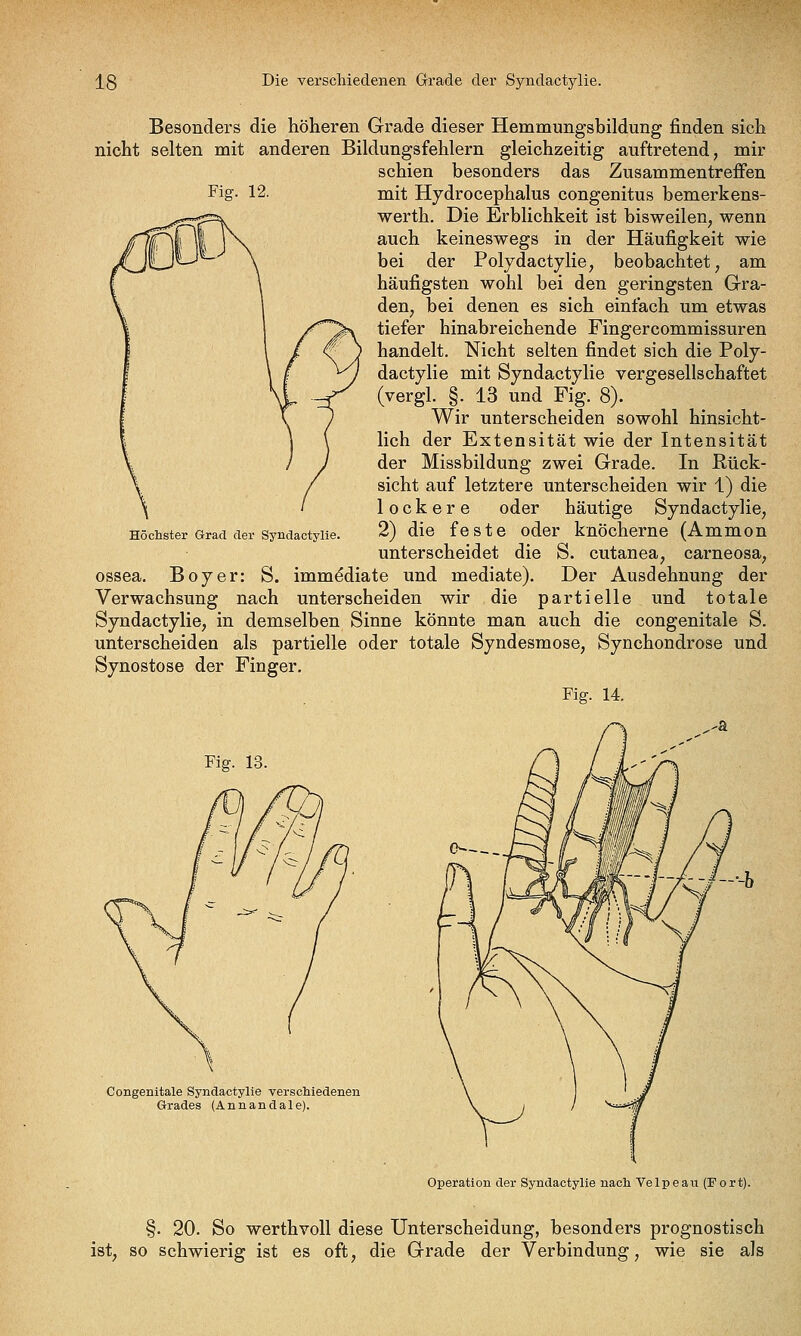 Fig. 12. Besonders die höheren Grade dieser Hemmungsbildung finden sich nicht selten mit anderen Bildungsfehlern gleichzeitig auftretend, mir schien besonders das Zusammentreffen mit Hydrocephalus congenitus bemerkens- werth. Die Erblichkeit ist bisweilen, wenn auch keineswegs in der Häufigkeit wie bei der Polydactylie, beobachtet, am häufigsten wohl bei den geringsten Gra- den, bei denen es sich einfach um etwas tiefer hinabreichende Fingercommissuren handelt. Nicht selten findet sich die Poly- dactylie mit Syndactylie vergesellschaftet (vergl. §. 13 und Fig. 8). Wir unterscheiden sowohl hinsicht- lich der Extensität wie der Intensität der Missbildung zwei Grade. In Rück- sicht auf letztere unterscheiden wir 1) die lockere oder häutige Syndactylie, 2) die feste oder knöcherne (Ammon unterscheidet die S. cutanea, carneosa, ossea. Boy er: S. imm^diate und mediate). Der Ausdehnung der Verwachsung nach unterscheiden wir die partielle und totale Syndactylie, in demselben Sinne könnte man auch die congenitale S. unterscheiden als partielle oder totale Syndesmose, Synchondrose und Synostose der Finger. Fig. 14. Höchster Grad cler Syndactylie. Fig. 13. Congenitale Syndactylie verscliiedenen Grades (Annandale). Operation der Syndactylie nach Velpeaii (Fort). §. 20. So werthvoll diese Unterscheidung, besonders prognostisch ist, so schwierig ist es oft, die Grade der Verbindung, wie sie als