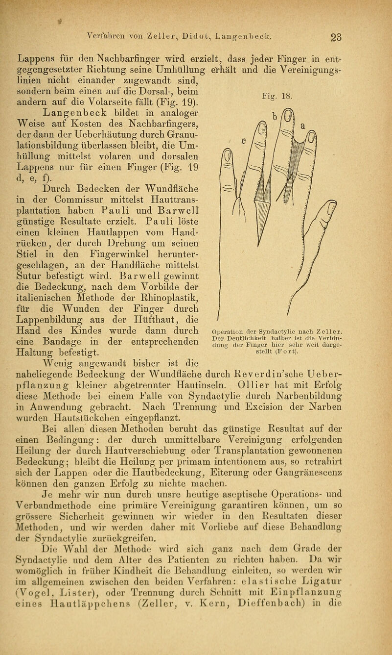 Fiff. 18. Lappens für den Nachbarfinger wird erzielt, dass jeder Finger in ent- gegengesetzter Richtung seine Umhüllung erhält und die Vereinigungs- linien nicht einander zugewandt sind, sondern beim einen auf die Dorsal-, beim andern auf die Volarseite fällt (Fig. 19). Langenbeck bildet in analoger Weise auf Kosten des Nachbarfingers, der dann der IJeberhäutung durch Granu- lationsbildung überlassen bleibt, die Um- hüllung mittelst volaren und dorsalen Lappens nur für einen Finger (Fig. 19 d, e, f). Durch Bedecken der Wundfläche in der Commissur mittelst Hauttrans- plantation haben Pauli und Bar well günstige Resultate erzielt. Pauli löste einen kleinen Hautlappen vom Hand- rücken, der durch Drehung um seinen Stiel in den Fingerwinkel herunter- geschlagen, an der Handfläche mittelst Sutur befestigt wird. Bar well gewinnt die Bedeckung, nach dem Vorbilde der italienischen Methode der Rhinoplastik, für die Wunden der Finger durch Lappenbildung aus der Hüfthaut, die Hand des Kindes wurde dann durch eine Bandage in der entsprechenden Haltung befestigt. Wenig angewandt bisher ist die naheliegende Bedeckung der Wundfläche durch Reverdin'sche Ueber- pflanz ung kleiner abgetrennter Hautinseln. Ol Her hat mit Erfolg diese Methode bei einem Falle von Syndactylie durch Narbenbildung in Anwendung gebracht. Nach Trennung und Excision der Narben wurden Hautstückchen eingepflanzt. Bei allen diesen Methoden beruht das günstige Resultat auf der einen Bedingung: der durch unmittelbare Vereinigung erfolgenden Heilung der durch Hautverschiebung oder Transplantation gewonnenen Bedeckung; bleibt die Heilung per primam intentjonem aus, so retrahirt sich der Lappen oder die Hautbedeckung, Eiterung oder Gangränescenz können den ganzen Erfolg zu nichte machen. Je mehr wir nun durch unsre heutige aseptische Operations- und Verbandmethode eine primäre Vereinigung garantiren können, um so grössere Sicherheit gewinnen wir wieder in den Resultaten dieser Methoden, und wir werden daher mit Vorliebe auf diese Behandlimg der Syndactylie zurückgreifen. Die Wahl der Methode wird sich ganz nach dem Grade der Syndactylie und dem Alter des Patienten zu richten haben. Da wir womöglich in früher Kindheit die ]khandlung einleit(^n, so werden wir im allgemeinen zwischen den beiden Verfahren: elastische Ligatur (Vogel, Lister), oder Trennung durch Schnitt mit Einpflanzung eines Hautläppchens (Zeller, v. Kern, Dieffenbach) in die Operation der Syndactylie nach Zeller. Der Deutlichkeit halber ist die Verbin- dung der Finger hier sehr weit darge- stellt (Fort).