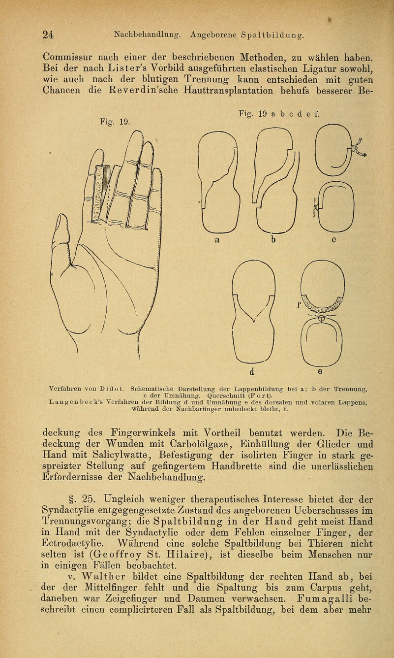 Commissur nach einer der beschriebenen Methoden, zu wählen haben. Bei der nach List er's Vorbild ausgeführten elastischen Ligatur sowohl, wie auch nach der blutigen Trennung kann entschieden mit guten Chancen die Reverdin'sche Hauttransplantation behufs besserer Be- Fig. 19. Verfahren von Didot. Schematisohe Darstellung der Lappenbildung bei a; b der Trennung, c der Umnähung. Querschnitt (F o r t). Langenbeck's Verfahren der Bildung d und Umnähung e des dorsalen vind volaren Lappens, während der Nachbarfinger unbedeckt bleibt, f. deckung des Fingerwinkels mit Vortheil benutzt werden. Die Be- deckung der Wunden mit Carbolölgaze, Einhüllung der Glieder und Hand mit Salicylwatte, Befestigung der isolirten Finger in stark ge- spreizter Stellung auf gefingertem Handbrette sind die unerlässlichen Erfordernisse der Nachbehandlung. §. 25. Ungleich weniger therapeutisches Interesse bietet der der Syndactylie entgegengesetzte Zustand des angeborenen Ueberschusses im TrennungsVorgang; die Spaltbildung in der Hand geht meist Hand in Hand mit der Sjndactylie oder dem Fehlen einzelner Finger, der Ectrodactylie. Während eine solche Spaltbildung bei Thieren nicht selten ist (Geoffroy St. Hilaire), ist dieselbe beim Menschen nur in einigen Fällen beobachtet. V. Walther bildet eine Spaltbildung der rechten Hand ab, bei der der Mittelfinger fehlt und die Spaltung bis zum Carpus geht, daneben war Zeigefinger und Daumen verwachsen. Fumagalli be- schreibt einen complicirteren Fall als Spaltbildung, bei dem aber mehr
