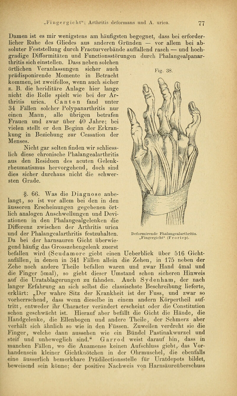 Fig. 38. Damen ist es mir wenigstens am häufigsten begegnet, dass bei erforder- licher Ruhe des Gliedes aus anderen Gründen — vor allem bei ab- soluter Feststellung durch Fracturverbände auffallend rasch — und hoch- gradige DifFormitäten und Functionsstörungen durch Phalangealpanar- thritis sich einstellen. Dass neben solchen örtlichen Veranlassungen sicher auch prädisponirende Momente in Betracht kommen, ist zweifellos, wenn auch sicher z. B. die heriditäre Anlage hier lange nicht die Rolle spielt wie bei der Ar- thritis urica, C a n t o n fand unter 34 Fällen solcher Polypanarthritis nur einen Mann, alle übrigen betrafen Frauen und zwar über 40 Jahre; bei vielen stellt er den Beginn der Erkran- kung in Beziehung zur Cessation der Menses. Nicht gar selten finden wir schliess- lich diese chronische Phalangealarthritis aus den Residuen des acuten Gelenk- rheumatismus hervorgehend, doch sind dies sicher durchaus nicht die schwer- sten Grade. §. 66. Was die Diagnose anbe- langt, so ist vor allem bei den in den äusseren Erscheinungen gegebenen ört- lich analogen Anschwellungen und Devi- ationen in den Phalangealgelenken die Differenz zwischen der Arthritis urica und der Phalangealarthritis festzuhalten. Da bei der harnsauren Gicht überwie- gend häufig das Grosszehengelenk zuerst befallen wird (Scudamore giebt einen Ueberblick über 516 Gicht- anfällen, in denen in 341 Fällen allein die Zehen, in 175 neben der Zehe noch andere Theile befallen waren und zwar Hand 4mal und die Finger 5mal), so giebt dieser Umstand schon sicheren Hinweis auf die Uratablagerungen zu fahnden. Auch Sjdenham, der nach langer Erfahrung an sich selbst die classischste Beschreibung lieferte, erklärt: „Der wahre Sitz der Krankheit ist der Fuss, und zwar so vorherrschend, dass wenn dieselbe in einem andern Körpertheil auf- tritt , entweder ihr Character verändert erscheint oder die Constitution schon geschwächt ist. Hierauf aber befällt die Gicht die Hände, die Handgelenke, die Ellenbogen und andere Theile, der Schmerz aber verhält sich ähnlich so wie in den Füssen. Zuweilen verdreht sie die Finger, welche dann aussehen wie ein Bündel Pastinakwurzel und steif und unbeweglich sind.'' Garrod weist darauf hin, dass in manchen Fällen, wo die Anamense keinen Aufschluss giebt, das Vor- handensein kleiner Gichtknötchen in der Ohrmuschel, die ebenfalls eine äusserlich bemerkbare Prädilectionsstelle für Uratdepots bildet, beweisend sein könne; der positive Nachweis von Harnsäureüberschuss Deformirende Plialaiigealartliritis. „Fingergicht (Froriep).