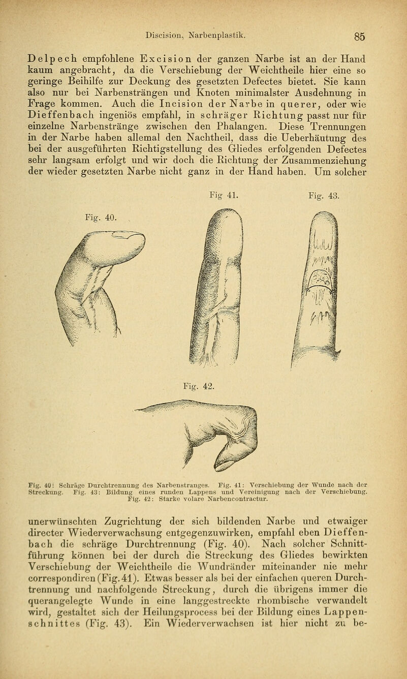 D e 1 p e ch empfohlene Excision der ganzen Narbe ist an der Hand kaum angebracht, da die Verschiebung der Weichtheile hier eine so geringe Beihilfe zur Deckung des gesetzten Defectes bietet. Sie kann also nur bei JSTarbensträngen und Knoten minimalster Ausdehnung in Frage kommen. Auch die Incision der Narbe in querer, oder wie Dieffenbach ingeniös empfahl, in schräger Richtung passt nur für einzelne Narbenstränge zwischen den Phalangen. Diese Trennungen in der Narbe haben allemal den Nachtheil, dass die Ueberhäutung des bei der ausgeführten Richtigstellung des Gliedes erfolgenden Defectes sehr langsam erfolgt und wir doch die Richtung der Zusammenziehung der wieder gesetzten Narbe nicht ganz in der Hand haben. Um solcher Fig 41. Fig. 43. Fig. 40. Fig. 42. Fig. 40: Schräge Durchtrennung des Narbenstrauges. Fig. il: Verschiebung der Wunde nach der Streckung. Fig. 43: Bildung eines runden Lappens iind Vereinigung nach der Verschiebung. Fig. 42: Starke volare Narbencontractur. unerwünschten Zugrichtung der sich bildenden Narbe und etwaiger directer Wiederverwachsung entgegenzuwirken, empfahl eben Dieffen- bach die schräge Durchtrennung (Fig. 40). Nach solcher Schnitt- führung können bei der durch die Streckung des Gliedes bewirkten Verschiebung der Weichtheile die Wundränder miteinander nie mehr corre8pondiren(Fig.41). Etwas besser als bei der einfachen queren Durch- trennung und nachfolgende Streckung, durch die übrigens immer die querangelegte Wunde in eine langgestreckte rhombische verwandelt wird, gestaltet sich der Heilungsproccss bei der Bildung eines Lappen- schnittes (Fig. 43). Ein Wiederverwachsen ist hier nicht zu be-
