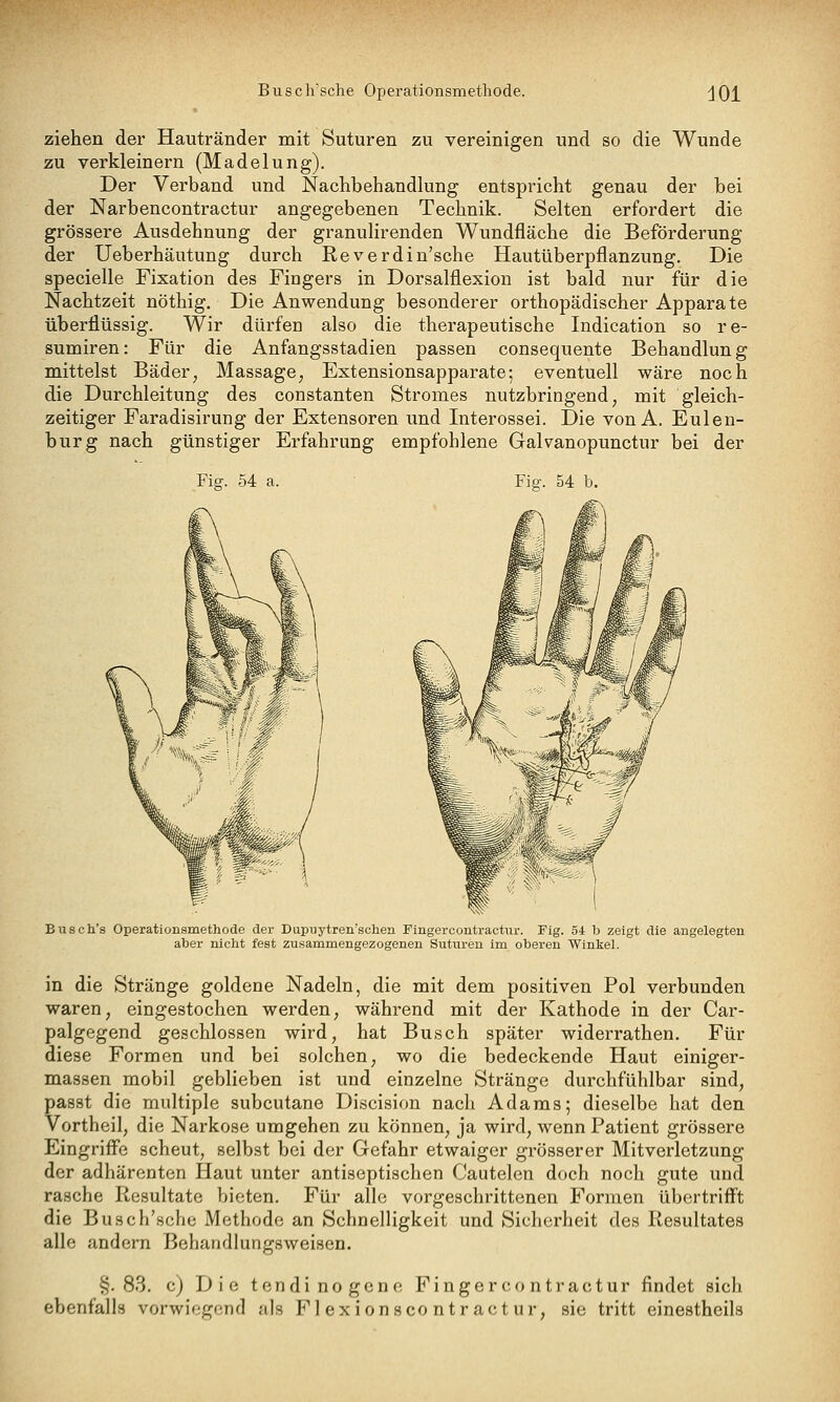 B u s c li'sche Operationsmethode. dOl ziehen der Hautränder mit Suturen zu vereinigen und so die Wunde zu verkleinern (Madelung). Der Verband und Nachbehandlung entspricht genau der bei der Narbencontractur angegebenen Technik. Selten erfordert die grössere Ausdehnung der granulirenden Wundfläche die Beförderung der Ueberhäutung durch Reverdin'sche Hautüberpflanzung. Die specielle Fixation des Fingers in Dorsalflexion ist bald nur für die Nachtzeit nöthig. Die Anwendung besonderer orthopädischer Apparate überflüssig. Wir dürfen also die therapeutische Indication so re- sumiren: Für die Anfangsstadien passen consequente Behandlung mittelst Bäder, Massage; Extensionsapparate; eventuell wäre noch die Durchleitung des constanten Stromes nutzbringend, mit gleich- zeitiger Faradisirung der Extensoren und Interossei. Die von A. Eulen- burg nach günstiger Erfahrung empfohlene Galvanopunctur bei der Fig. 54 a. Busch's Operationsmethode der Diipuytren'schen Fingercontractur. Fig. 54 b zeigt die angelegten aber nicht fest zusammengezogenen Suturen im oberen Winkel. in die Stränge goldene Nadeln, die mit dem positiven Pol verbunden waren, eingestochen werden, während mit der Kathode in der Car- palgegend geschlossen wird, hat Busch später widerrathen. Für diese Formen und bei solchen, wo die bedeckende Haut einiger- massen mobil geblieben ist und einzelne Stränge durchfühlbar sind, passt die multiple subcutane Discision nach Adams; dieselbe hat den Vortheil, die Narkose umgehen zu können, ja wird, wenn Patient grössere Eingriffe scheut, selbst bei der Gefahr etwaiger grösserer Mitverletzung der adhärenten Haut unter antiseptischen Cautelen doch noch gute und rasche Resultate bieten. Für alle vorgeschrittenen Formen übertrifft die Busch'sche Methode an Schnelligkeit und Siclierheit des Resultates alle andern Behandlungsweisen. §.83. c) D i e tendinogene Fingercontractur findet sich ebenfalls vorwiegend als Fl exionsco ntr actur, sie tritt einestheils