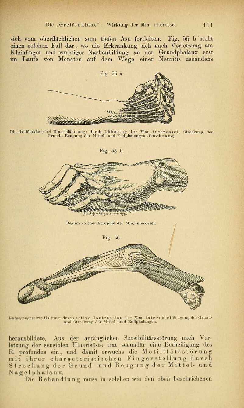 sich vom oberflächlichen zum tiefen Ast fortleiten. Fig. 55 b stellt einen solchen Fall dar, wo die Erkrankung sich nach Verletzung am Kleinfinger und wulstiger Narbenbildung an der Grundphalanx erst im Laufe von Monaten auf dem Wege einer Neuritis ascendens Fig. .55 a. Die Greifenklavie bei Ulnarislähnmng: durch Lähmiiug der Mm. interossei, Streckung der Grund-, Beugung der Mittel- und Endphalangen (Duchenne). Fig. 55 b. r U L; Qor u JihoTolyp, Beginn solcher Atrophie der Mm. interossei. Fig. 56 Entgegengesetzte Haltung: durch active Contraction der Mm. interossei Beugung der Gruud- und Streckung der Mittel- und Endphalangen. herausbildete. Aus der anfänglichen Sensibilitätsstörung nach Ver- letzung der sensiblen Ulnarisäste trat secundär eine Betheiligung des R. profundus ein, und damit erwuchs die Motilitätsstörung mit ihrer characte ristischen Fingerstellung durch Streckung der Grund- und Beugung der Mittel- und Nagel phalanx. Die Behandlung muss in solchen wie den eben beschriebenen