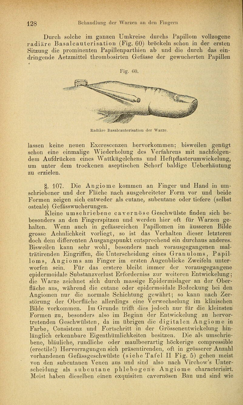 Durch solche im ganzen Umkreise durchs Papillom vollzogene radiäre Basalcauterisation (Fig. 60) bröckeln schon in der ersten Sitzung die prominenten Papillenparthien ab und die durch das ein- dringende Aetzmittel thrombosirten Gefasse der gewucherten Papillen Fig. 60. Radiäre Basalcauterisation der Warze. lassen keine neuen Excrescenzen hervorkommen; bisweilen genügt schon eine einmalige Wiederholung des Verfahrens mit nachfolgen- dem Aufdrücken eines Wattkügelchens und Heftpflasterumwickelung, um unter dem trockenen aseptischen Schorf baldige Ueberhäutung zu erzielen. §. 107. Die Angiome kommen an Finger und Hand in um- schriebener und der Fläche nach ausgebreiteter Form vor und beide Formen zeigen sich entweder als cutane, subcutane oder tiefere (selbst osteale) Gefässwucherungen. Kleine umschriebene cavernöse Geschwülste finden sich be- besonders an den Fingerspitzen und werden hier oft für Warzen ge- halten. Wenn auch in gefässreichen Papillomen im äusseren Bilde grosse Aehnlichkeit vorliegt, so ist das Verhalten dieser letzteren doch dem differenten Ausgangspunkt entsprechend ein durchaus anderes. Bisweilen kann sehr wohl, besonders nach vorausgegangenen mal- trätirenden Eingriffen, die Unterscheidung eines Granuloms, Papil- loms, Angioms am Finger im ersten Augenblicke Zweifeln unter- worfen sein. Für das erstere bleibt immer der vorausgegangene epidermoidale Substanzverlust Erforderniss zur weiteren Entwickelung; die Warze zeichnet sich durch massige Epidermislager an der Ober- fläche aus, während die cutane oder epidermoidale Bedeckung bei den Angiomen nur die normale Schichtung gewährt-, so kann nach Zer- störung der Oberfläche allerdings eine Verwechselung im klinischen Bilde vorkommen. Im Grunde trifft dies jedoch nur für die kleinsten Formen zu, besonders also im Beginn der Entwickelung zu hervor- tretenden Geschwülsten, da im übrigen die digitalen Angiome in Farbe, Consistenz und Fortschritt in der Grössenentwickelung hin- länglich erkennbare Eigenthümlichkeiten besitzen. Die als umschrie- bene, bläuliche, rundliche oder maulbeerartig höckerige compressible (erectile!) Hervorragungen sich präsentirenden, oft in grösserer Anzahl vorhandenen Gefässgeschwülste (siehe Tafel II Fig. 5) gehen meist von den subcutanen Venen aus und sind also nach Virchow's Unter- scheidung als subcutane phlebogene Angiome characterisirt. Meist haben dieselben einen exquisiten cavernösen Bau und sind wie
