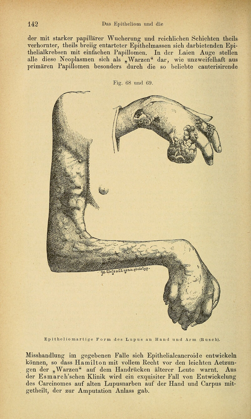 der mit starker papillärer Wucherung und reichlichen Schichten theils verhornter, theils breiig entarteter Epithelmassen sich darbietenden Epi- thelialkrebsen mit einfachen Papillomen. In der Laien Auge stellen alle diese Neoplasmen sich als „Warzen dar, wie unzweifelhaft aus primären Papillomen besonders durch die so beliebte cauterisirende Fig. 68 und 69. Epitheliomartige Form des Lupus an Hand und Arm (Buscli). Misshandlung im gegebenen Falle sich Epithelialcancroide entwickeln können, so dass Hamilton mit vollem Recht vor den leichten Aetzun- gen der „Warzen auf dem Handrücken älterer Leute warnt. Aus der Esmarch'schen Klinik wird ein exquisiter Fall von Entwickelung des Carcinomes auf alten Lupusnarben auf der Hand und Carpus mit- getheilt, der zur Amputation Anlass gab.