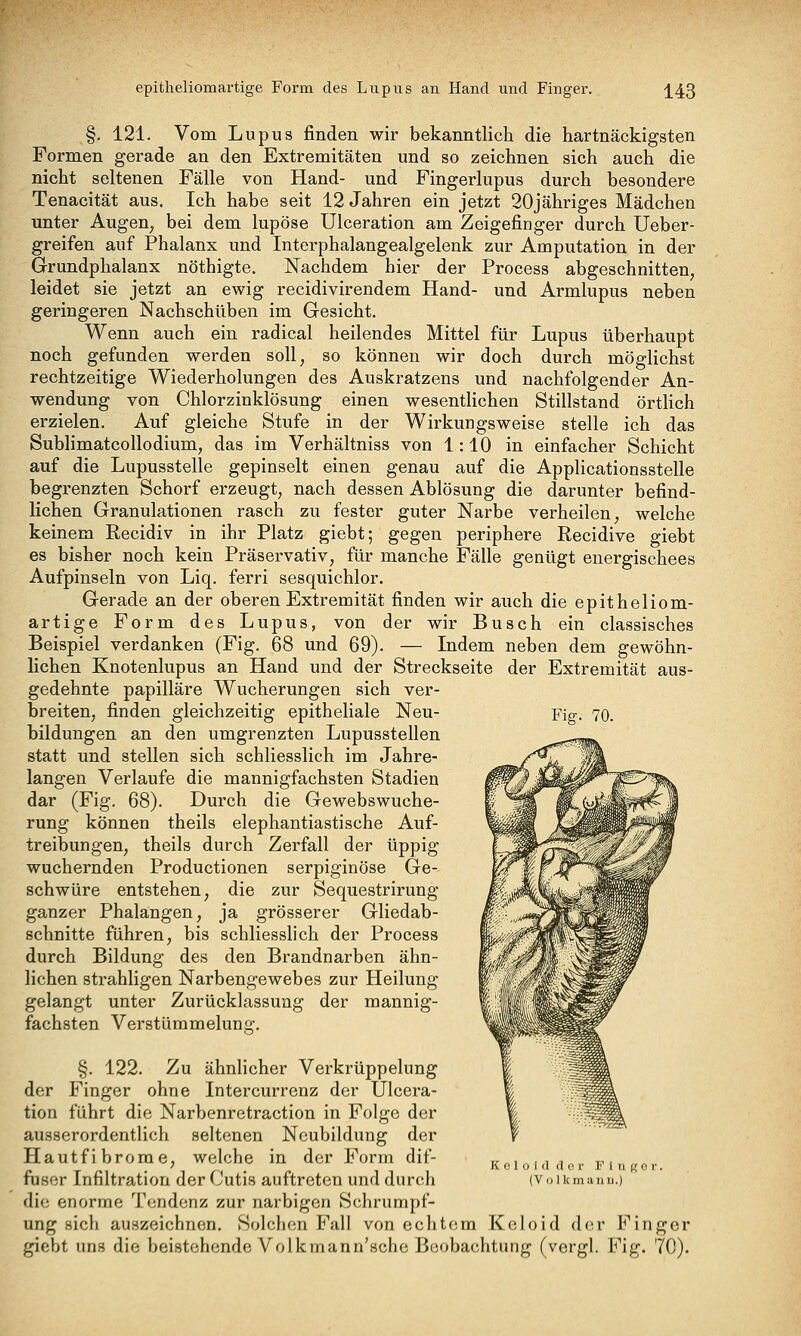 epitheliomartige Form des Lupus an Hand und Finger. j^43 §. 121. Vom Lupus finden wir bekanntlich die hartnäckigsten Formen gerade an den Extremitäten und so zeichnen sich auch die nicht seltenen Fälle von Hand- und Fingerlupus durch besondere Tenacität aus. Ich habe seit 12 Jahren ein jetzt 20jähriges Mädchen unter Augen, bei dem lupöse Ulceration am Zeigefinger durch Ueber- greifen auf Phalanx und Interphalangealgelenk zur Amputation in der Grundphalanx nöthigte. Nachdem hier der Process abgeschnitten, leidet sie jetzt an ewig recidivirendem Hand- und Armlupus neben geringeren Nachschüben im Gesicht. Wenn auch ein radical heilendes Mittel für Lupus überhaupt noch gefunden werden soll, so können wir doch durch möglichst rechtzeitige Wiederholungen des Auskratzens und nachfolgender An- wendung von Chlorzinklösung einen wesentHchen Stillstand örtlich erzielen. Auf gleiche Stufe in der Wirkungsweise stelle ich das Sublimatcollodium, das im Verhältniss von 1:10 in einfacher Schicht auf die Lupusstelle gepinselt einen genau auf die Applicationsstelle begrenzten Schorf erzeugt, nach dessen Ablösung die darunter befind- lichen Granulationen rasch zu fester guter Narbe verheilen, welche keinem Recidiv in ihr Platz giebt; gegen periphere Recidive giebt es bisher noch kein Präservativ, für manche Fälle genügt energischees Aufpinseln von Liq. ferri sesquichlor. Gerade an der oberen Extremität finden wir auch die epitheliom- artige Form des Lupus, von der wir Busch ein classisches Beispiel verdanken (Fig. 68 und 69). — Indem neben dem gewöhn- lichen Knotenlupus an Hand und der Streckseite der Extremität aus- gedehnte papilläre Wucherungen sich ver- breiten, finden gleichzeitig epitheliale Neu- Fig. 70. bildungen an den umgrenzten Lupusstellen ^.-^r-Timv statt und stellen sich schliesslich im Jahre- /^M. f^ langen Verlaufe die mannigfachsten Stadien ^^^J^^^^^^^^l%k dar (Fig. 68). Durch die Gewebswuche- | ^^^ W^^^^^^m rung können theils elephantiastische Auf- ^^^ X^^^m^^ treibungen, theils durch Zerfall der üppig %^^'^^^^^S^m wuchernden Productionen serpiginöse Ge- vfwT'W^^^^^W schwüre entstehen, die zur Sequestrirung J('.i!*^%vW^1^^^P ganzer Phalangen, ja grösserer Gliedab- J^'' ,>j^^^^^^^^M, schnitte führen, bis schliesslich der Process w^^'ji^^^^^^^^ durch Bildung des den Brandnarben ahn- %Mw^' '^^^^F liehen strahligen Narbengewebes zur Heilung % ''ii-i0M--^^^^ gelangt unter Zurücklassung der mannig- l/|iii'^^^^^^ fachsten Verstümmelung. ^i^^^^^^^^ §. 122. Zu ähnlicher Verkrüppelung 1 ^^^ der Finger ohne Intercurrenz der Ulcera- 1 --^^^ tion führt die Narbenretraction in Folge der 1 v^^^a ausserordentlich seltenen Neubildung der f Hautfibrorae, welche in der Form dif- „,. ,, , ,,. ruser Infiltration der Cutis auftreten und durch (Voikmaim.) die enorme Tendenz zur narbigen Schrumpf- ung sich auszeichnen. Solchen Fall von echtem Keloid d(!r Finger giebt uns die beistehende Volkmann'sche Beobachtung (vergl. Fig. 70).