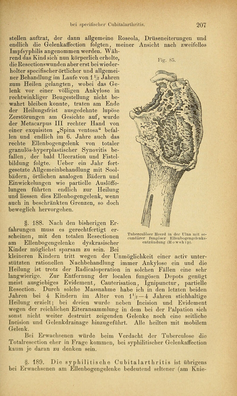 Fiff. 85. stellen auftrat, der dann allgemeine Roseola, Drüseneiteruogen und endlich die Gelenkaffection folgten, meiner Ansicht nach zweifellos Impfsyphilis angenommen werden. Wäh- rend das Kind sich nun körperlich erholte, die Resections wunden aber erst bei wieder- holter specifischer örtlicher und allgemei- ner Behandlung im Laufe von 1 ^J2 Jahren zum Heilen gelangten, wobei das Ge- lenk vor einer völligen Ankylose in rechtwinkliger Beugestellung nicht be- wahrt bleiben konnte, traten am Ende der Heilungsfrist ausgedehnte lupöse Zerstörungen am Gesichte auf, wurde der Metacarpus III rechter Hand von einer exquisiten „Spina ventosa befal- len und endlich im 6. Jahre auch das rechte Ellenbogengelenk von totaler granulös-hyperplastischer Synovitis be- fallen, der bald Ulceration und Fistel- bildung folgte. Ueber ein Jahr fort- gesetzte Allgemeinbehandlung mit Sool- bädern, örtlichen analogen Bädern und Einwickelungen wie partielle Auslöffe- lungen führten endlich zur Heilung und liessen dies Ellenbogengelenk, wenn auch in beschränkten Grenzen, so doch beweglich hervorgehen. Tiiberculöser Heercl In der TJlna mit se- cvindärer fungöser Ellenbogengelenks- entzündung (Howship). §. 188. Nach den bisherigen Er- fahrungen muss es gerechtfertigt er- scheinen, mit den totalen Resectionen am Ellenbogengelenke dyskrasischer Kinder möglichst sparsam zu sein. Bei kleineren Kindern tritt wegen der Unmöglichkeit einer activ unter- stützten rationellen Nachbehandlung immer Ankylose ein und die Heilung ist trotz der Radicaloperation in solchen Fällen eine sehr langwierige. Zur Entfernung der localen fungösen Depots genügt meist ausgiebiges Evidement, Cauterisation, Ignipunctur, partielle Resection. Durch solche Massnahme habe ich in den letzten beiden Jahren bei 4 Kindern im Alter von l'/2—4 Jahren stichhaltige Heilung erzielt; bei dreien wurde neben Tncision und Evidement wegen der reichlichen Eiteransammlung in dem bei der Palpation sich sonst nicht weiter destruirt zeigenden Gelenke noch eine seitliche Incision und Gelenkdrainage hinzugeführt. Alle heilten mit mobilem Gelenk. Bei Erwachsenen würde beim Verdacht der Tuberculose die Totalresection eher in Frage kommen, bei syphilitischer Gelenkaifection kaum je daran zu denken sein. §. 189. Die syphilitische Cubitalarthritis ist übrigens bei Erwachsenen am Ellenbogengelenke bedeutend seltener (am Knie-