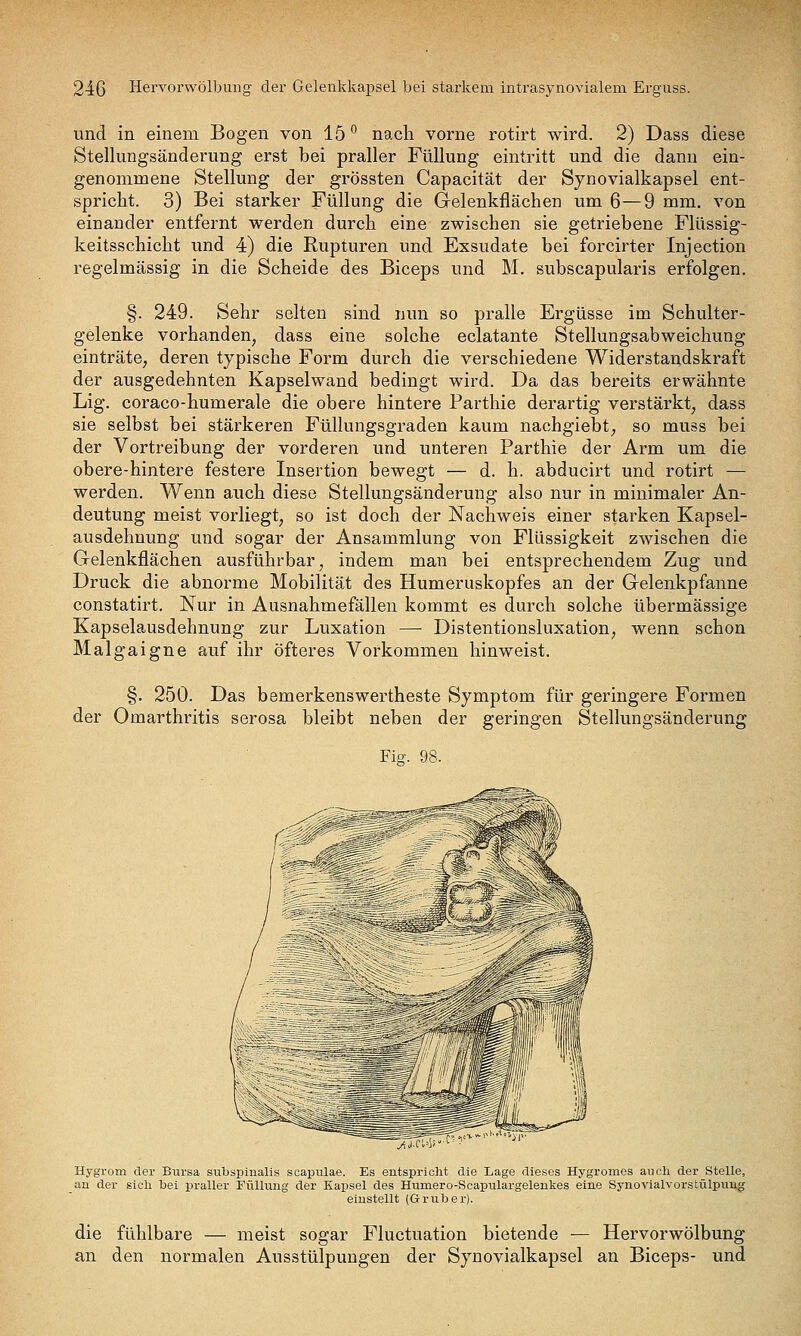 und in einem Bogen von lö*' nach vorne rotirt wird. 2) Dass diese Stellungsänderung erst bei praller Füllung eintritt und die dann ein- genommene Stellung der grössten Capacität der Synovialkapsel ent- spricht. 3) Bei starker Füllung die Gelenkflächen um 6—9 mm. von einander entfernt werden durch eine zwischen sie getriebene Flüssig- keitsschicht und 4) die Rupturen und Exsudate bei forcirter Injection regelmässig in die Scheide des Biceps und M. subscapularis erfolgen. §. 249. Sehr selten sind nun so pralle Ergüsse im Schulter- gelenke vorhanden, dass eine solche eclatante Stellungsabweichung einträte, deren typische Form durch die verschiedene Widerstandskraft der ausgedehnten Kapselwand bedingt wird. Da das bereits erwähnte Lig. coraco-humerale die obere hintere Parthie derartig verstärkt, dass sie selbst bei stärkeren Füllungsgraden kaum nachgiebt, so muss bei der Vortreibung der vorderen und unteren Parthie der Arm um die obere-hintere festere Insertion bewegt — d. h. abducirt und rotirt — werden. Wenn auch diese Stellungsänderung also nur in minimaler An- deutung meist vorliegt, so ist doch der Nachweis einer starken Kapsel- ausdehnung und sogar der Ansammlung von Flüssigkeit zwischen die Gelenkflächen ausführbar, indem man bei entsprechendem Zug und Druck die abnorme Mobilität des Humeruskopfes an der Gelenkpfanne constatirt. Nur in Ausnahmefällen kommt es durch solche übermässige Kapselausdehnung zur Luxation — Distentionsluxation, wenn schon Malgaigne auf ihr öfteres Vorkommen hinweist. §. 250. Das bemerkenswertheste Symptom für geringere Formen der Omarthritis serosa bleibt neben der geringen Stellungsänderung Fig. 98. ^j.r.'v Hygrom der Bursa subspinalis scapulae. Es eutsiJricht die Lage dieses Hygromes auch, der Stelle, an der sieh bei praller Füllung der Kapsel des Humero-Scapulargelenkes eine Synovialvorstülpung einstellt (Gruber). die fühlbare — meist sogar Fluctuation bietende — Hervorwölbung an den normalen Ausstülpungen der Synovialkapsel an Biceps- und