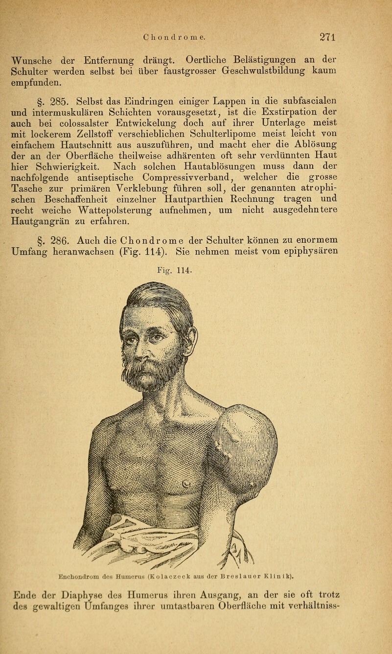 Wunsche der Entfernung drängt. Oertliche Belästigungen an der Schulter werden selbst bei über faustgrosser Geschwulstbildung kaum empfunden. §. 285. Selbst das Eindringen einiger Lappen in die subfascialen und intermuskulären Schichten vorausgesetzt, ist die Exstirpation der auch bei colossalster Entwickelung doch auf ihrer Unterlage meist mit lockerem Zellstoff verschieblichen Schulterlipome meist leicht von einfachem Hautschnitt aus auszuführen, und macht eher die Ablösung der an der Oberfläche theilweise adhärenten oft sehr verdünnten Haut hier Schwierigkeit. Nach solchen Hautablösungen muss dann der nachfolgende antiseptische Compressivverband, welcher die grosse Tasche zur primären Verklebung führen soll, der genannten atrophi- schen Beschaffenheit einzelner Hautparthien Rechnung tragen und recht weiche Wattepolsterung aufnehmen, um nicht ausgedehntere Hautgangrän zu erfahren. §. 286. Auch die Chondrome der Schulter können zu enormem Umfang heranwachsen (Fig. 114). Sie nehmen meist vom epiphysären Fiff. 114. Enchondrom de« HumeniH (Kolaczock aus dor Broslauor Klinik). Ende der Diaphyse des Huraerus ihren Ausgang, an der sie oft trotz des gewaltigen Ümfanges ihrer uratastbaren Oberfläche mit Verhältnis»-