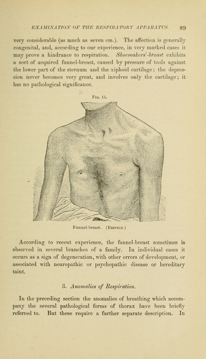 very considerable (as much as seven cm.). The aifection is generally congenital, and, according to our experience, in very marked cases it may prove a hindrance to respiration. Shoemakers'-bf-east exhibits a sort of acquired funnel-breast, caused by pressure of tools against the lower part of the sternum and the xiphoid cartilage; the depres- sion never becomes very great, and involves only the cartilage; it' has no pathological significance. Fig. 15. J'unnel-breast. (Ebstein.) According to recent experience, the funnel-breast sometimes is observed in several branches of a family. In individual cases it occurs as a sign of degeneration, with other errors of development, or associated with neuropathic or psychopathic disease or hereditary taint. 3. Anomalies of JRespiration. In the preceding section the anomalies of breathing which accom- pany thie several pathological forms of thorax have been briefly referred to. But these require a further separate description. In