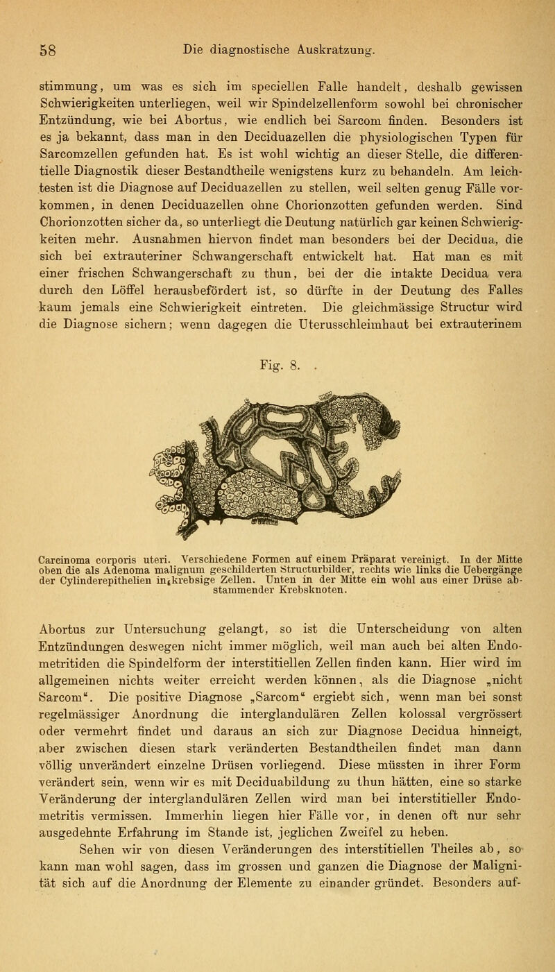 Stimmung, um was es sich im specielJen Falle handelt, deshalb gewissen Schwierigkeiten unterliegen, weil wir Spindelzellenform sowohl bei chronischer Entzündung, wie bei Abortus, wie endlich bei Sarcom finden. Besonders ist es ja bekannt, dass man in den Deciduazellen die physiologischen Typen für Sarcomzellen gefunden hat. Es ist wohl wichtig an dieser Stelle, die differen- tielle Diagnostik dieser Bestandtheile wenigstens kurz zu behandeln. Am leich- testen ist die Diagnose auf Deciduazellen zu stellen, weil selten genug Fälle vor- kommen, in denen Deciduazellen ohne Chorionzotten gefunden werden. Sind Chorionzotten sicher da, so unterliegt die Deutung natürlich gar keinen Schwierig- keiten mehr. Ausnahmen hiervon findet man besonders bei der Decidua, die sich bei extrauteriner Schwangerschaft entwickelt hat. Hat man es mit einer frischen Schwangerschaft zu thun, bei der die intakte Decidua vera durch den Löfi'el herausbefördert ist, so dürfte in der Deutung des Falles kaum jemals eine Schwierigkeit eintreten. Die gleichmässige Structur wird die Diagnose sichern; wenn dagegen die Uterusschleimhaat bei extrauterinem Fig. 8. Carcinoma corporis uteri. Verschiedene Formen auf einem Präparat vereinigt. In der Mitte oben die als Adenoma malignum geschilderten Structurbilder, rechts wie links die Uebergänge der CylinderepitheUen inikrebsige Zellen. Unten in der Mitte ein wohl aus einer Drüse ab- stammender Krebsknoten. Abortus zur Untersuchung gelangt, so ist die Unterscheidung von alten Entzündungen deswegen nicht immer möglich, weil man auch bei alten Endo- metritiden die Spindelform der interstitiellen Zellen finden kann. Hier wird im allgemeinen nichts weiter erreicht werden können, als die Diagnose „nicht Sarcom. Die positive Diagnose „Sarcom ergiebt sich, wenn man bei sonst regelmässiger Anordnung die interglandulären Zellen kolossal vergrössert oder vermehrt findet und daraus an sich zur Diagnose Decidua hinneigt, aber zwischen diesen stark veränderten Bestandtheilen findet man dann völlig unverändert einzelne Drüsen vorliegend. Diese müssten in ihrer Form verändert sein, wenn wir es mit Deciduabildung zu thun hätten, eine so starke Veränderung der interglandulären Zellen wird man bei interstitieller Endo- metritis vermissen. Immerhin liegen hier Fälle vor, in denen oft nur sehr ausgedehnte Erfahrung im Stande ist, jeglichen Zweifel zu heben. Sehen wir von diesen Veränderungen des interstitiellen Theiles ab, so kann man wohl sagen, dass im grossen und ganzen die Diagnose der Maligni- tät sich auf die Anordnung der Elemente zu einander gründet. Besonders auf-