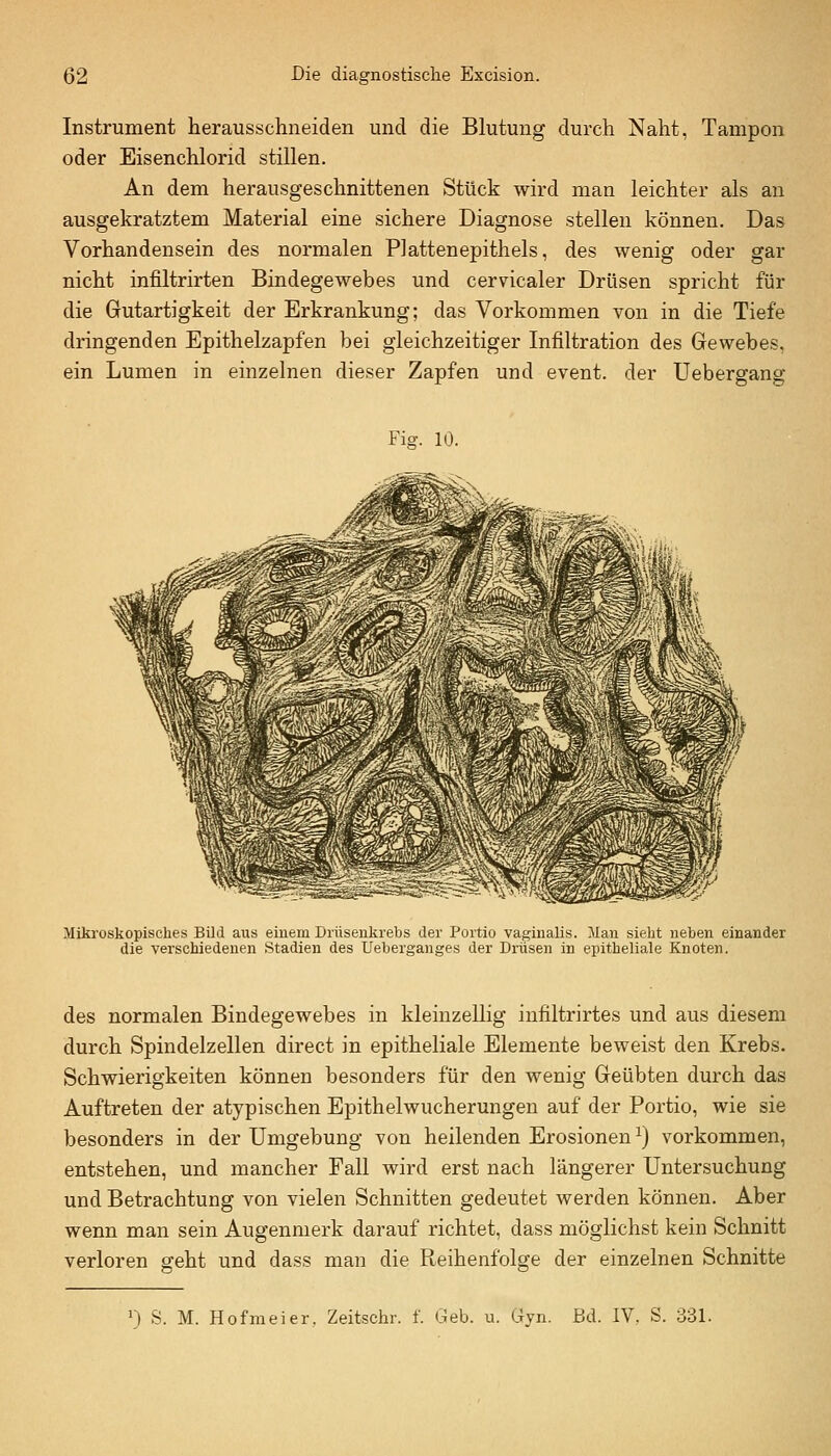 Instrument herausschneiden und die Blutung durch Naht, Tampon oder Eisenchlorid stillen. An dem herausgeschnittenen Stück wird man leichter als an ausgekratztem Material eine sichere Diagnose stellen können. Das Vorhandensein des normalen PJattenepithels, des wenig oder gar nicht infiltrirten Bindegewebes und cervicaler Drüsen spricht für die Gutartigkeit der Erkrankung; das Vorkommen von in die Tiefe dringenden Epithelzapfen bei gleichzeitiger Infiltration des Gewebes, ein Lumen in einzelnen dieser Zapfen und event. der Uebergang Fisf. 10. Miki'oskopisches Bild aus einem Drüsenkrebs der Portio vaginalis. Man sieht neben einander die verschiedenen Stadien des Ueberganges der Drüsen in epitheliale Knoten. des normalen Bindegewebes in kleinzellig infiltrirtes und aus diesem durch Spindelzellen direct in epitheliale Elemente beweist den Krebs. Schwierigkeiten können besonders für den wenig Geübten durch das Auftreten der atypischen Epithelwucherungen auf der Portio, wie sie besonders in der Umgebung von heilenden Erosionen ^) vorkommen, entstehen, und mancher Fall wird erst nach längerer Untersuchung und Betrachtung von vielen Schnitten gedeutet werden können. Aber wenn man sein Augenmerk darauf richtet, dass möglichst kein Schnitt verloren geht und dass man die Reihenfolge der einzelnen Schnitte 0 S. M. Hofmeier, Zeitschr. f. Geb. u. Gyn. Bd. IV, S. 331.