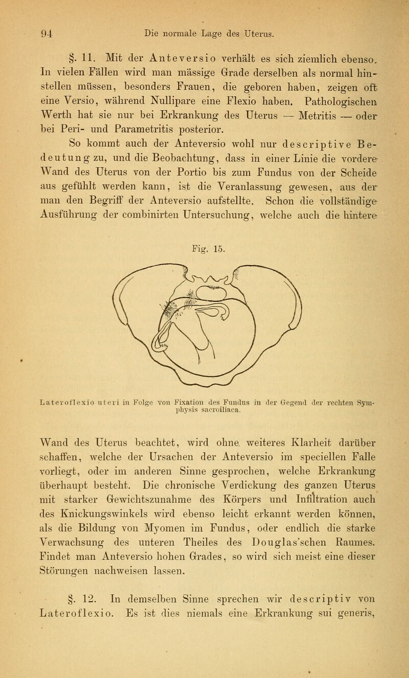 §.11. Mit der Anteversio verhält es sich ziemlich ebenso. In vielen Fällen wird man massige Grade derselben als normal hin- stellen müssen, besonders Frauen, die geboren haben, zeigen oft eine Versio, vrährend Nullipare eine Flexio haben. Pathologischen Werth hat sie nur bei Erkrankung des Uterus — Metritis — oder bei Peri- und Parametritis posterior. So kommt auch der Anteversio wohl nur descriptive Be- deutung zu, und die Beobachtung, dass in einer Linie die vordere Wand des Uterus von der Portio bis zum Fundus von der Scheide aus gefühlt werden kann, ist die Veranlassung gewesen, aus der man den Begriff der Anteversio aufstellte. Schon die vollständige Ausführung der combinirten Untersuchung, welche auch die hintere Fig. 15. Latei'oflexio uteri in Folge von Fixation des Fundus in der Gegend der rechten Sym- physis sacroiliaca. Wand des Uterus beachtet, wird ohne, weiteres Klarheit darüber schaffen, welche der Ursachen der Anteversio im speciellen Falle vorliegt, oder im anderen Sinne gesprochen, welche Erkrankung überhaupt besteht. Die chronische Verdickung des ganzen Uterus mit starker Gewichtszunahme des Körpers und Infiltration auch des Knickungswinkels wird ebenso leicht erkannt werden können, als die Bildung von Myomen im Fundus, oder endlich die starke Verwachsung des unteren Theiles des Douglas'schen Raumes. Findet man Anteversio hohen Grades, so wird sich meist eine dieser Störungen nachweisen lassen. §. 12. In demselben Sinne sprechen wir descriptiv von Lateroflexio. Es ist dies niemals eine Erkrankung sui generis,