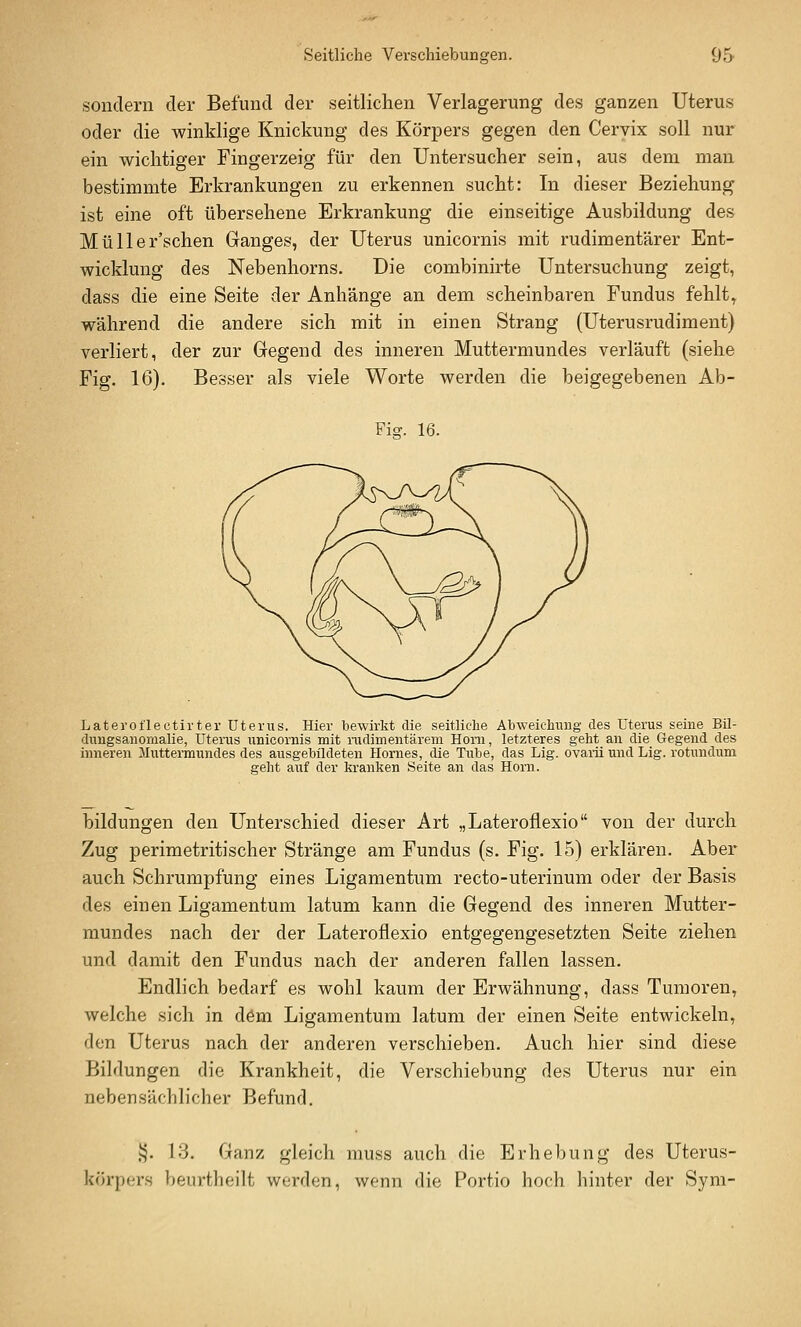 sondern der Befund der seitlichen Verlagerung des ganzen Uterus oder die winklige Knickung des Körpers gegen den Ceryix soll nur ein wichtiger Fingerzeig für den Untersucher sein, aus dem man bestimmte Erkrankungen zu erkennen sucht: In dieser Beziehung ist eine oft übersehene Erkrankung die einseitige Ausbildung des Müller'schen Ganges, der Uterus unicornis mit rudimentärer Ent- wicklung des Nebenhorns. Die combinirte Untersuchung zeigt, dass die eine Seite der Anhänge an dem scheinbaren Fundus fehlte während die andere sich mit in einen Strang (Uterusrudiment) verliert, der zur Gregend des inneren Muttermundes verläuft (siehe Fig. 16). Besser als viele Worte werden die beigegebenen Ab- Fi^. 16. Lateroflectirter Uterus. Hier bewirkt die seitliche Abweicliimg des Uterus seine Bil- dungsanomalie, Uterus unicornis mit radimentärem Honi, letzteres geht an die Gegend des inneren Muttermundes des ausgebildeten Hornes, die Tube, das Lig. ovaiü und Lig. rotundum geht auf der kranken Seite an das Hörn. bildungen den Unterschied dieser Art „Lateroflexio von der durch Zug perimetritischer Stränge am Fundus (s. Fig. 15) erklären. Aber auch Schrumpfung eines Ligamentum recto-uterinum oder der Basis des einen Ligamentum latum kann die Gegend des inneren Mutter- mundes nach der der Lateroflexio entgegengesetzten Seite ziehen und damit den Fundus nach der anderen fallen lassen. Endlich bedarf es wohl kaum der Erwähnung, dass Tumoren, welche sich in dem Ligamentum latum der einen Seite entwickeln, den Uterus nach der anderen verschieben. Auch hier sind diese Bildungen die Krankheit, die Verschiebung des Uterus nur ein nebensächlicher Befund. ^5. 13. Ganz gleich muss auch die Erhebung des Uterus- körpers beurtheilt werden, wenn die Portio hoch hinter der Sym-