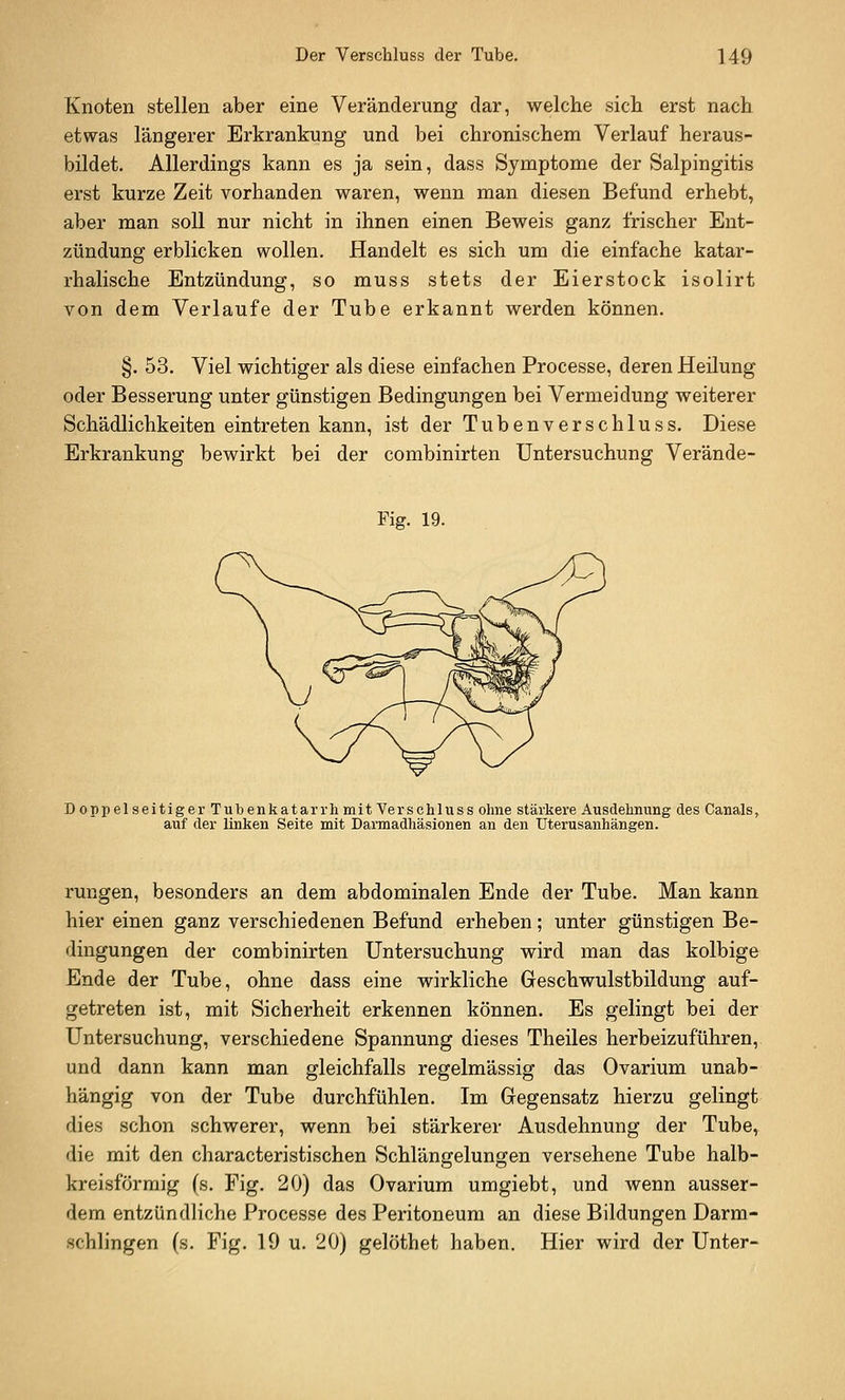 Knoten stellen aber eine Veränderung dar, welche sich erst nach etwas längerer Erkrankung und bei chronischem Verlauf heraus- bildet. Allerdings kann es ja sein, dass Symptome der Salpingitis erst kurze Zeit vorhanden waren, wenn man diesen Befund erhebt, aber man soll nur nicht in ihnen einen Beweis ganz Irischer Ent- zündung erblicken wollen. Handelt es sich um die einfache katar- rhalische Entzündung, so muss stets der Eierstock isolirt von dem Verlaufe der Tube erkannt werden können. §. 53. Viel wichtiger als diese einfachen Processe, deren Heilung oder Besserung unter günstigen Bedingungen bei Vermeidung weiterer Schädlichkeiten eintreten kann, ist der Tubenverschluss. Diese Erkrankung bewirkt bei der combinirten Untersuchung Verände- Fig. 19. Doppelseitiger Tubenkatarrh mit Verschluss ohne stärkere Ausdehnung des Canals, auf der linken Seite mit Darmadhäsionen an den Uterusanhängen. rungen, besonders an dem abdominalen Ende der Tube. Man kann hier einen ganz verschiedenen Befund erheben; unter günstigen Be- dingungen der combinirten Untersuchung wird man das kolbige Ende der Tube, ohne dass eine wirkliche Geschwulstbildung auf- getreten ist, mit Sicherheit erkennen können. Es gelingt bei der Untersuchung, verschiedene Spannung dieses Theiles herbeizuführen, und dann kann man gleichfalls regelmässig das Ovarium unab- hängig von der Tube durchfühlen. Im Gegensatz hierzu gelingt dies schon schwerer, wenn bei stärkerer Ausdehnung der Tube, die mit den characteristischen Schlängelungen versehene Tube halb- kreisförmig (s. Fig. 20) das Ovarium umgiebt, und wenn ausser- dem entzündliche Processe des Peritoneum an diese Bildungen Darm- schlingen (s. Fig. 19 u. 20) gelöthet haben. Hier wird der Unter-