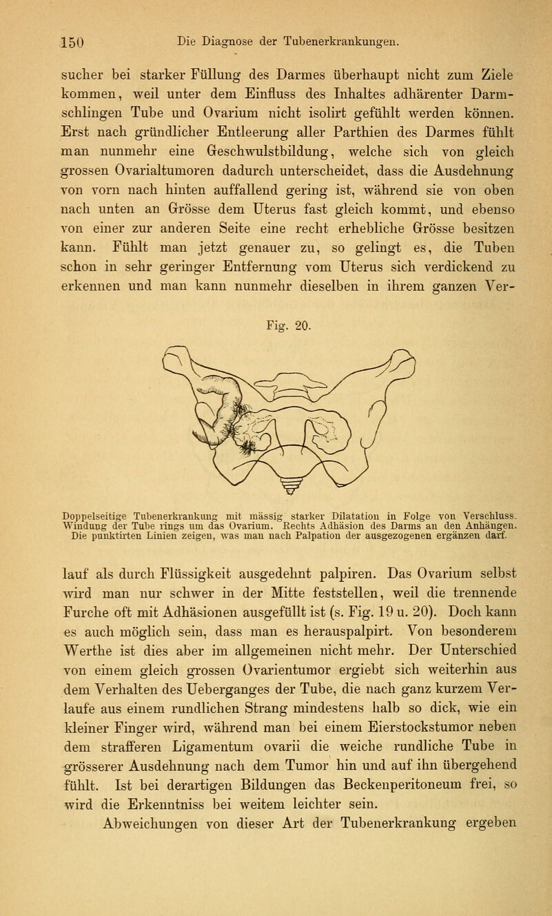 suclier bei starker Füllung des Darmes überhaupt niclit zum Ziele kommen, weil unter dem Einfluss des Inhaltes adhärenter Darm- schlingen Tube und Ovarium nicht isolirt gefühlt werden können. Erst nach gründlicher Entleerung aller Parthien des Darmes fühlt man nunmehr eine Geschwulstbildung, welche sich von gleich grossen Ovarialtumoren dadurch unterscheidet, dass die Ausdehnung von vorn nach hinten auffallend gering ist, während sie von oben nach unten an Grösse dem Uterus fast gleich kommt, und ebenso von einer zur anderen Seite eine recht erhebliche Grösse besitzen kann. Fühlt man jetzt genauer zu, so gelingt es, die Tuben schon in sehr geringer Entfernung vom Uterus sich verdickend zu erkennen und man kann nunmehr dieselben in ihrem ganzen Ver- Fig. 20. Doppelseitige Tubenerkrankimg mit massig starker Dilatation in Folge von Verschluss. Windung der Tube rings um das Ovarium. Rechts Adhäsion des Darms an den Anhängen. Die punktirten Linien zeigen, was man nach Palpatiou der ausgezogenen ergänzen darf. lauf als durch Flüssigkeit ausgedehnt palpiren. Das Ovarium selbst wird man nur schwer in der Mitte feststellen, weil die trennende Furche oft mit Adhäsionen ausgefüllt ist (s. Fig. 19 u. 20). Doch kann es auch möghch sein, dass man es herauspalpirt. Von besonderem Werthe ist dies aber im allgemeinen nicht mehr. Der Unterschied von einem gleich grossen Ovarientumor ergiebt sich weiterhin aus dem Verhalten des Ueberganges der Tube, die nach ganz kurzem Ver- laufe aus einem rundlichen Strang mindestens halb so dick, wie ein kleiner Finger wird, während man bei einem Eierstockstumor neben dem strafferen Ligamentum ovarii die weiche rundliche Tube in grösserer Ausdehnung nach dem Tumor hin und auf ihn übergehend fühlt. Ist bei derartigen Bildungen das Beckeuperitoneum frei, so wird die Erkenntniss bei weitem leichter sein. Abweichungen von dieser Art der Tubenerkrankung ergeben