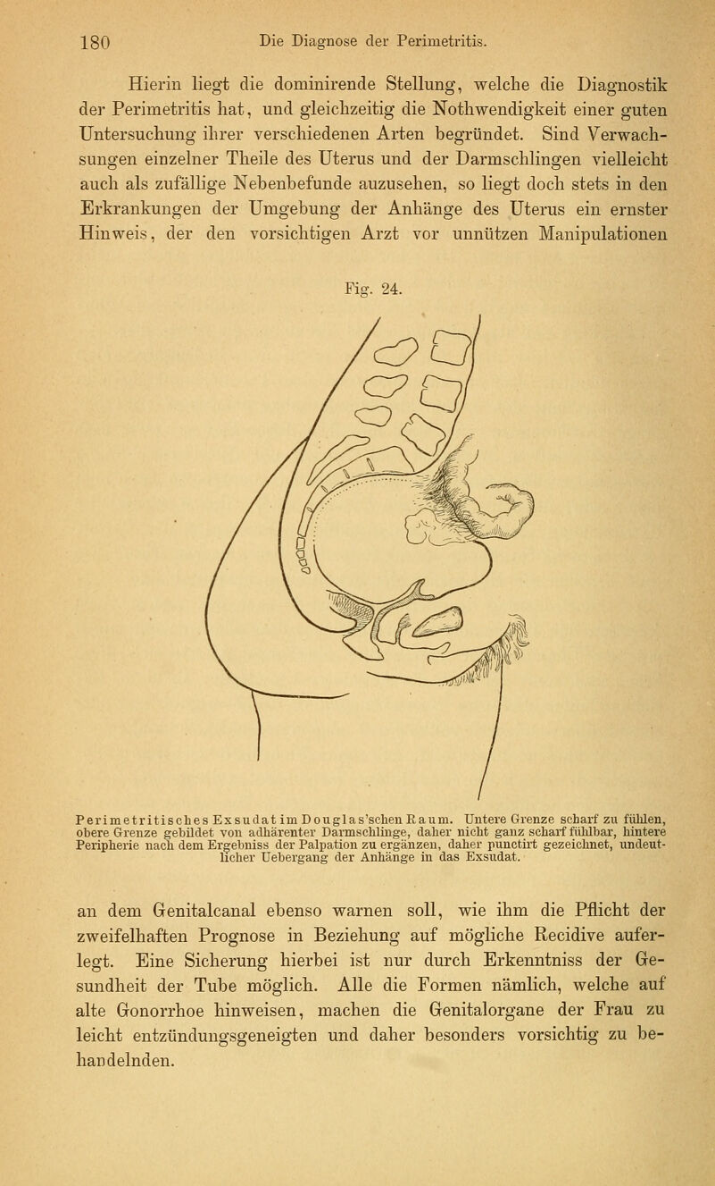 Hierin liegt die dominirende Stellung, welche die Diagnostik der Perimetritis hat, und gleichzeitig die Nothwendigkeit einer guten Untersuchung ihrer verschiedenen Arten begründet. Sind Verwach- sungen einzelner Theile des Uterus und der Darmschlingen vielleicht auch als zufällige Nebenbefunde anzusehen, so liegt doch stets in den Erkrankungen der Umgebung der Anhänge des Uterus ein ernster Hinweis, der den vorsichtigen Arzt vor unnützen Manipulationen Fio-. 24. Perimetritisches Exsudat im Douglas'schen Raum. Untere Grenze scharf zu fühlen, obere Grenze gebildet von adhärenter Darmschlinge, daher nicht ganz scharf fühlbar, hintere Peripherie nach dem Er^ebniss der Palpation zu ergänzen, daher punctirt gezeichnet, undeut- licher Uebergang der Anhänge in das Exsudat. an dem Genitalcanal ebenso warnen soll, wie ihm die Pflicht der zweifelhaften Prognose in Beziehung auf mögliche Recidive aufer- legt. Eine Sicherung hierbei ist nur durch Erkenntniss der Ge- sundheit der Tube möglich. Alle die Formen nämlich, welche auf alte Gonorrhoe hinweisen, machen die Genitalorgane der Frau zu leicht entzündungsgeneigten und daher besonders vorsichtig zu be- handelnden.