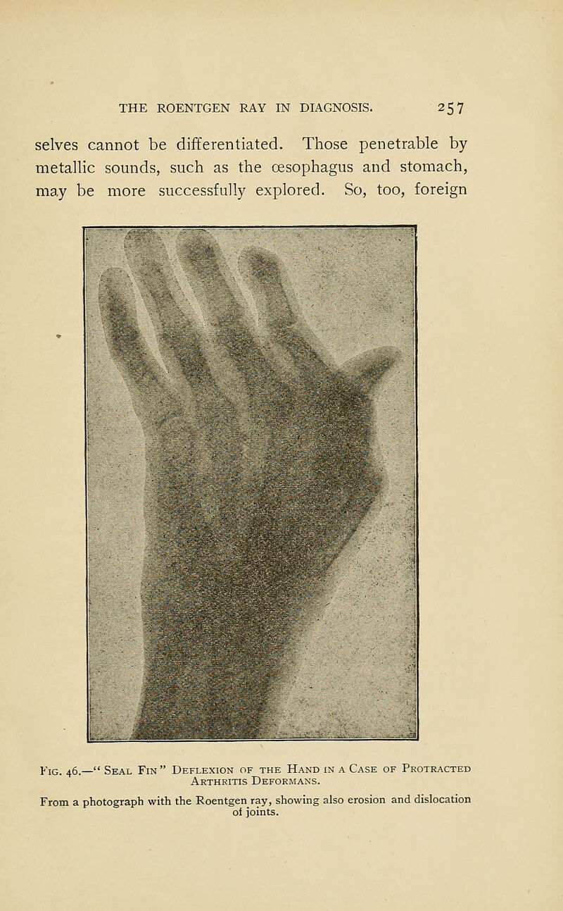 selves cannot be differentiated. Those penetrable by metallic sounds, such as the oesophagus and stomach, may be more successfully explored. So, too, foreign Fig. 46.— Seal Fin  Deflexion of the Hand in a Case of Protracted Arthritis Deformans. From a photograph with the Roentgen ray, showing also erosion and dislocation oi joints.