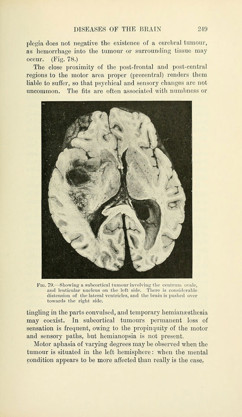 plegia does not negative the existence of a cerebral tumour, as hemorrhage into the tumour or surrounding tissue may occur. (Fig. 78.) The close proximity of the post-frontal and post-central regions to the motor area proper (precentral) renders them liable to suffer, so that psychical and sensory changes are not uncommon. The fits are often associated with numbness or Fig. 79.—Showing a subcortical tumour involving the centrum ovale, and lenticular nucleus on the left side. There is considerable distension of the lateral ventricles, and the brain is pushed over towards the right side. tingling in the parts convulsed, and temporary hemianesthesia may coexist. In subcortical tumours permanent loss of sensation is frequent, owing to the propinquity of the motor and sensory paths, but hemianopsia is not present. Motor aphasia of varying degrees may be observed when the tumour is situated in the left hemisphere: when the mental condition appears to be more affected than really is the case.