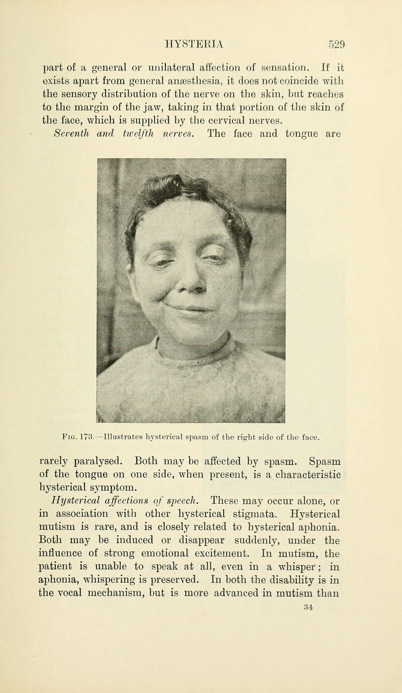 part of a general or unilateral affection of sensation. If it exists apart from general anaesthesia, it does not coincide with the sensory distribution of the nerve on the skin, but reaches to the margin of the jaw, taking in that portion of the skin of the face, which is supplied by the cervical nerves. Seventh and twelfth nerves. The face and tongue are ^^m h Fig. 173.—Illustrates hysterical spasm of the right side of the face. rarely paralysed. Both may be affected by spasm. Spasm of the tongue on one side, when present, is a characteristic hysterical symptom. Hysterical affections of speech. These may occur alone, or in association with other hysterical stigmata. Hysterical mutism is rare, and is closely related to hysterical aphonia. Both may be induced or disappear suddenly, under the influence of strong emotional excitement. In mutism, the patient is unable to speak at all, even in a whisper; in aphonia, whispering is preserved. In both the disability is in the vocal mechanism, but is more advanced in mutism than 34