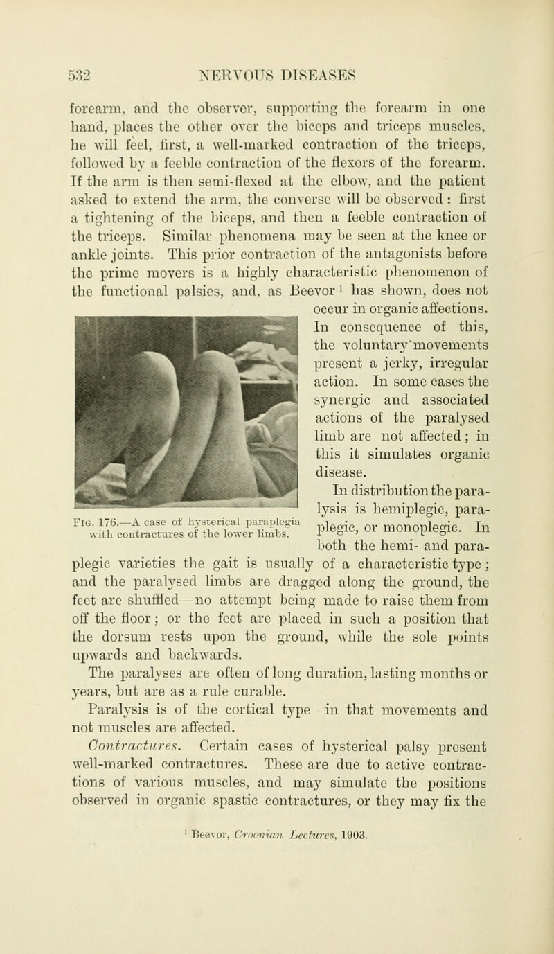 forearm, and the observer, supporting the forearm in one hand, places the other over the biceps and triceps muscles, he will feel, first, a well-marked contraction of the triceps, followed by a feeble contraction of the flexors of the forearm. If the arm is then semi-flexed at the elbow, and the patient asked to extend the arm, the converse will be observed : first a tightening of the biceps, and then a feeble contraction of the triceps. Similar phenomena may be seen at the knee or ankle joints. This prior contraction of the antagonists before the prime movers is a highly characteristic phenomenon of the functional palsies, and, as Beevor ' has shown, does not occur in organic affections. In consequence of this, the voluntaiymovements present a jerky, irregular action. In some cases the synergic and associated actions of the paralysed limb are not affected; in this it simulates organic disease. In distribution the para- lysis is hemiplegic, para- plegic, or monoplegic. In both the hemi- and para- plegic varieties the gait is usually of a characteristic type ; and the paralysed limbs are dragged along the ground, the feet are shuffled—no attempt being made to raise them from off the floor; or the feet are placed in such a position that the dorsum rests upon the ground, while the sole points upwards and backwards. The paralyses are often of long duration, lasting months or years, but are as a rule curable. Paralysis is of the cortical type in that movements and not muscles are affected. Contractures. Certain cases of hysterical palsy present well-marked contractures. These are due to active contrac- tions of various muscles, and ma}^ simulate the positions observed in organic spastic contractures, or they may fix the Fig. 170.—A case of hysterical paraplegia with contractures of the lower limbs. 1 Beevor, Croonian Lectures, 1903.