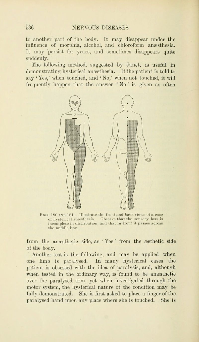 to another part of the body. It may disappear under the influence of morphia, alcohol, and chloroform anaesthesia. It may persist for years, and sometimes disappears quite suddenly. The following method, suggested by Janet, is useful in demonstrating hysterical anaesthesia. If the patient is told to Bay ' Yes,' when touched, and ' No,' when not touched, it will frequently happen that the answer ' No ' is given as often Fn;s. ISO ami INI.— Illustrate the front and back views of a case of hysterical anaesthesia. Observe that the sensory loss is incomplete in distribution, and that in front it passes across the middle line. from the anaesthetic side, as ' Yes' from the aesthetic side of the body. Another test is the following, and may be applied when one limb is paralysed. In many hysterical cases the patient is obsessed with the idea of paralysis, and, although when tested in the ordinary way, is found to be anaesthetic over the paralysed arm, yet when investigated through the motor system, the hysterical nature of the condition may be fully demonstrated. She is first asked to place a finger of the paralysed hand upon any place where she is touched. She is