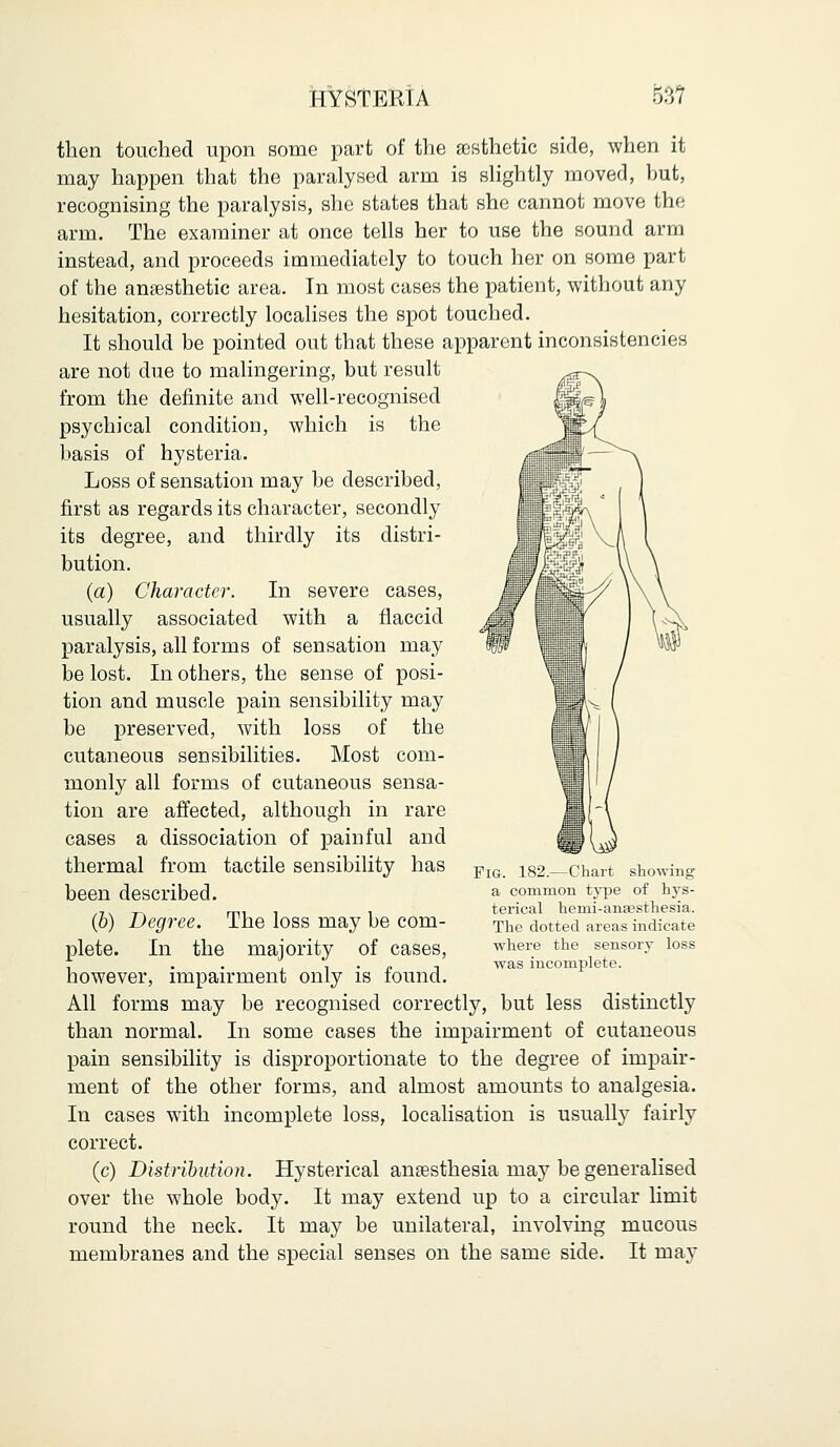 then touched upon some part of the aesthetic side, when it may happen that the paralysed arm is slightly moved, but, recognising the paralysis, she states that she cannot move the arm. The examiner at once tells her to use the sound arm instead, and proceeds immediately to touch her on some part of the anaesthetic area. In most cases the patient, without any hesitation, correctly localises the spot touched. It should be pointed out that these apparent inconsistencies are not due to malingering, but result from the definite and well-recognised psychical condition, which is the basis of hysteria. Loss of sensation may be described, first as regards its character, secondly its degree, and thirdly its distri- bution. (a) Character. In severe cases, usually associated with a flaccid paralysis, all forms of sensation may be lost. In others, the sense of posi- tion and muscle pain sensibility may be preserved, with loss of the cutaneous sensibilities. Most com- monly all forms of cutaneous sensa- tion are affected, although in rare cases a dissociation of painful and thermal from tactile sensibility has been described. (b) Degree. The loss may be com- plete. In the majority of cases, however, impairment only is found. All forms may be recognised correctly, but less distinctly than normal. In some cases the impairment of cutaneous pain sensibility is disproportionate to the degree of impair- ment of the other forms, and almost amounts to analgesia. In cases with incomplete loss, localisation is usually fairly correct. (c) Distribution. Hysterical anaesthesia may be generalised over the whole body. It may extend up to a circular limit round the neck. It may be unilateral, involving mucous membranes and the special senses on the same side. It may Pig. 182.—Chart showing a common type of hys- terical henii-anaesthesia. The dotted areas indicate where the sensory loss was incomplete.