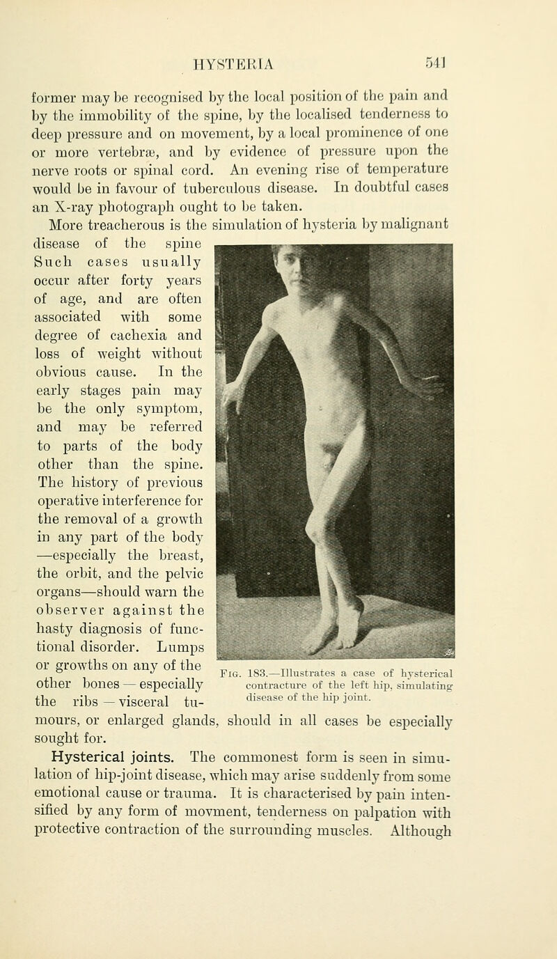 former may be recognised by the local position of the pain and by the immobility of the spine, by the localised tenderness to deep pressure and on movement, by a local prominence of one or more vertebrae, and by evidence of pressure upon the nerve roots or spinal cord. An evening rise of temperature would be in favour of tuberculous disease. In doubtful cases an X-ray photograph ought to be taken. More treacherous is the simulation of hysteria by malignant disease of the spine Such cases usually occur after forty years of age, and are often associated with some degree of cachexia and loss of weight without obvious cause. In the early stages pain may be the only symptom, and may be referred to parts of the body other than the spine. The history of previous operative interference for the removal of a growth in any part of the body —especially the breast, the orbit, and the pelvic organs—should warn the observer against the hasty diagnosis of func- tional disorder. Lumps or growths on any of the other bones — especially the ribs — visceral tu- mours, or enlarged glands, should in all cases be especially sought for. Hysterical joints. The commonest form is seen in simu- lation of hip-joint disease, which may arise suddenly from some emotional cause or trauma. It is characterised by pain inten- sified by any form of movment, tenderness on palpation with protective contraction of the surrounding muscles. Although ustrates a case of hysterical contracture of the left hip, simulating disease of the hip joint.