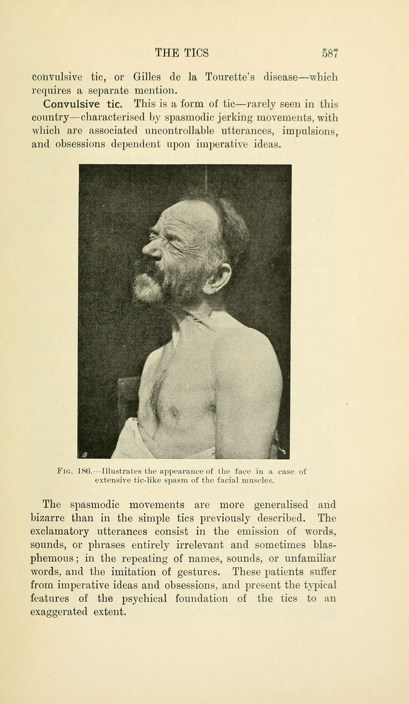 convulsive tic, or Gilles de la Tourette's disease—which requires a separate mention. Convulsive tic. This is a form of tic—rarely seen in this country—characterised by spasmodic jerking movements, with which are associated uncontrollable utterances, impulsions, and obsessions dependent upon imperative ideas. Fig. 186.—Illustrates the appearance of the face in a case of extensive tic-like spasm of the facial muscles. The spasmodic movements are more generalised and bizarre than in the simple tics previously described. The exclamatory utterances consist in the emission of words, sounds, or phrases entirely irrelevant and sometimes blas- phemous ; in the repeating of names, sounds, or unfamiliar words, and the imitation of gestures. These patients suffer from imperative ideas and obsessions, and present the typical features of the psychical foundation of the tics to an exaggerated extent.