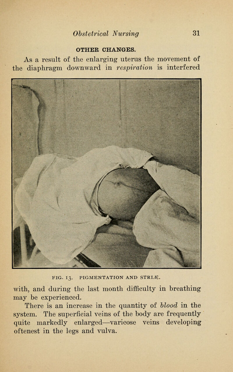 OTHER CHANGES. As a result of the enlarging uterus the movement of the diaphragm downward in respiration is interfered FIG. 13. PIGMENTATION AND STRI^. with, and daring the last month difficulty in breathing may be experienced. There is an increase in the quantity of blood in the system. The superficial veins of the body are frequently quite markedly enlarged—varicose veins developing oftenest in the legs and vulva.