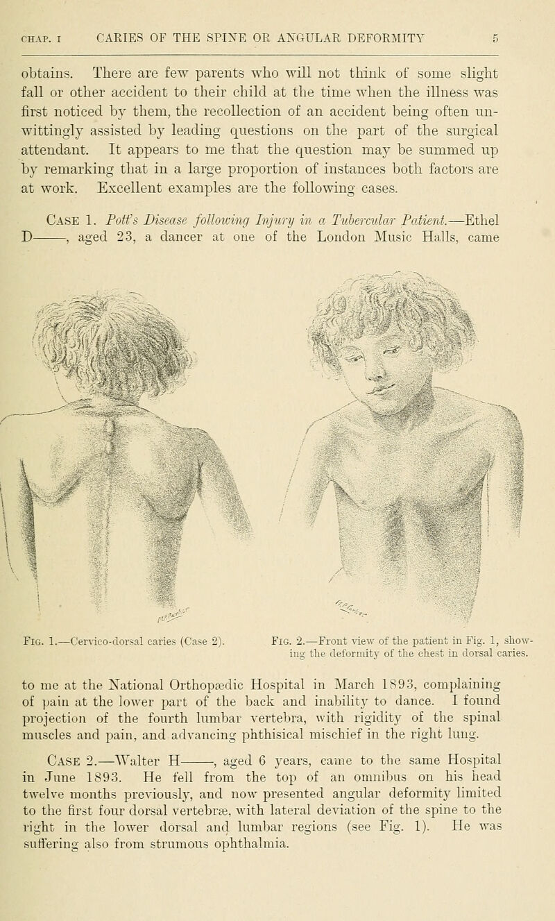 obtains. There are few parents who will not think of some slight fall or other accident to their child at the time when the illness was first noticed by them, the recollection of an accident being often un- wittingly assisted by leading questions on the part of the surgical attendant. It appears to me that the question may be summed up by remarking that in a large proportion of instances both factors are at work. Excellent examples are the following cases. Case 1. Pott's Disease following Injury in a Tubercular Patient.—Ethel D , aged 23, a dancer at one of the London Music Halls, came ym. \ 1%,V ^^' \ 1 : 1 \ % Fig. 1.—Cervico-dorsal caries (Case 2). Fig. 2.—Front view of the patient in Fig. 1, show- ing the deformity of the chest in dorsal caries. to me at the National Orthopaedic Hospital in March 1893, complaining of ]jain at the lower part of the back and inability to dance. I found projection of the fourth lumbar vertebra, with rigidity of the spinal muscles and pain, and advancing phthisical mischief in the right lung. Case 2.—Walter H , aged 6 years, came to the same Hospital in June 1893. He fell from the top of an omnibus on his head twelve months previously, and now presented angular deformity limited to the first four dorsal vertebrae, with lateral deviation of the spine to the right in the loAver dorsal and lumbar regions (see Fig. 1). He was sufferino- also from strumous ophthalmia.