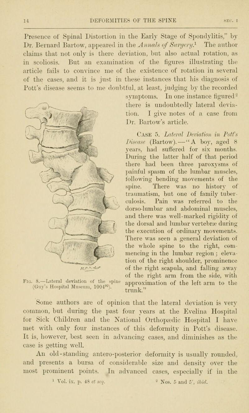 Presence of Spinal Distortion in the Early Stage of Spondylitis, by Dr. Bernard Bartow, appeared in the Annals of Surgrrji} The author claims that not only is there deviation, Init also actual rotation, as in scoliosis. But an examination of the figures illustrating the article fails to convince me of the existence of rotation in several of the cases, and it is just in these instances that his diagnosis of Pott's disease seems to me doubtful, at least, judging by the recorded symptoms. In one instance figured- there is undoubtedly lateral devia- ':■) tion. I give notes of a case from Dr. Bartow's article. Case 5. Lateral Deviation in Potfs Disease (Bartow).—A boy, aged 8 years, had suffered for six months. Dui'ing the latter half of that period there had been three paroxysms of painful spasm of the lumbar muscles, following bending movements of the spine. There was no histor}' of traumatism, but one of family tuber- culosis. Pain was referred to the dorso-lumbar and abdominal muscles, and there was well-marked rigidity of the dorsal and lumbar vertebra? during the execution of ordinary movements. There Avas seen a general deviation of the whole spine to the right, com- mencing in the lumbar region ; eleva- tion of the right shoulder, prominence of the right scapula, and falling away of the right arm from the side, with Lateral deviation of tlic^^spiue approximation of the left arm to the trunk. Fig. 8 (Giiy'.s Hospital Museum, 1004 Some authors are of opinion that the lateral deviation is very common, but during the past four years at the Evelina Hospital for Sick Children and the National Orthopaedic Hospital I have met with only four instances of this' deformity in Pott's disease. It is, however, best seen in advancing cases, and diminishes as the case is getting well. An old-standing antero-posterior deformity is usually rounded, and presents a bursa of considerable size and density over the most prominent points. In advanced cases, especially if in the