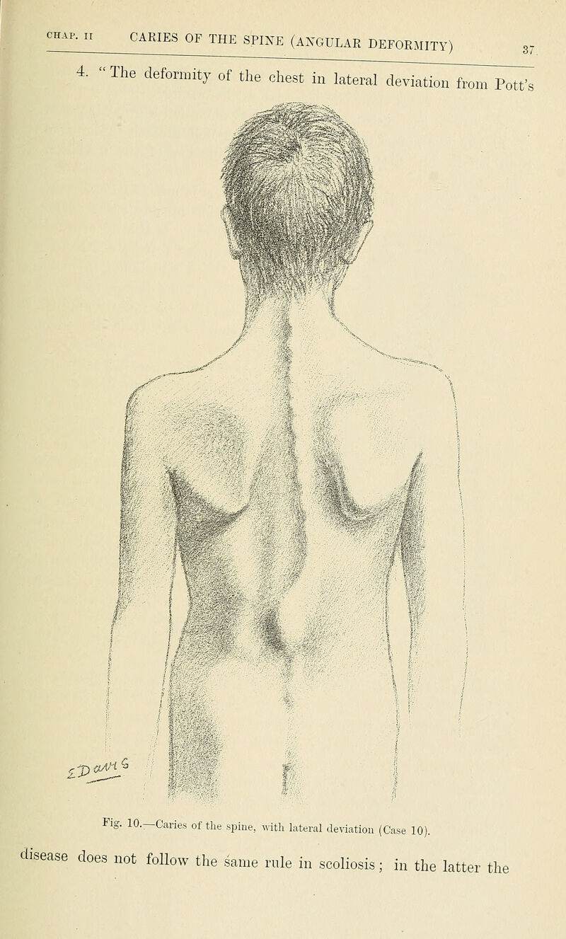 The defornnty of the chest in lateral deviation from Pott's ^;J)-^'^'i^-= s Fig. 10.—Caries of the spine, witli lateral deviation (Case 10). disease does not follow the same rule in scoliosis; in the latter the