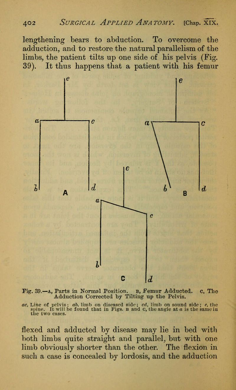 lengthening bears to abduction. To overcome the adduction, and to restore the natural parallelism of the limbs, the patient tilts up one side of his pelvis (Fig. 39). It thus happens that a patient with his femur (7, Fig, 39.—A, Parts in Normal Position, b, Femur Adducted. c, The Adduction Corrected by Tilting up the Pelvis. ac. Line of pelvis; a&, liml) on diseased side; cd, liml) on sound side; e, tlie spine. It will be found that in Figs, b and c, the angle at a is the sameiu the two cases. flexed and adducted by disease may lie in bed with both limbs quite straight and parallel, but with one limb obviously shorter than the other. The flexion in such a case is concealed by lordosis, and the adduction